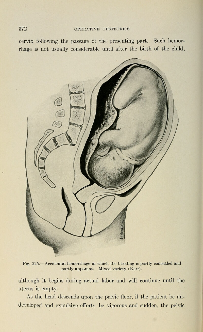 cervix following the passage of the presenting part. Such hemor- rhage is not usually considerable until after the birth of the child, Fig. 225.—Accidental hemorrhage in which the bleeding is partly concealed and partly apparent. Mixed variety (Kerr). although it begins during actual labor and will continue until the uterus is empty. As the head descends upon the pelvic floor, if the patient be un- developed and expulsive efforts be vigorous and sudden, the pelvic