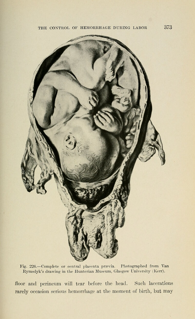 Fig. 226.—Complete or central placenta prsevia. Photographed from Van Rymsdyk's drawing in the Hunterian Museum, Glasgow University (Kerr). floor and perineum will tear before the head. Such lacerations rarely occasion serious hemorrhage at the moment of birth, but may