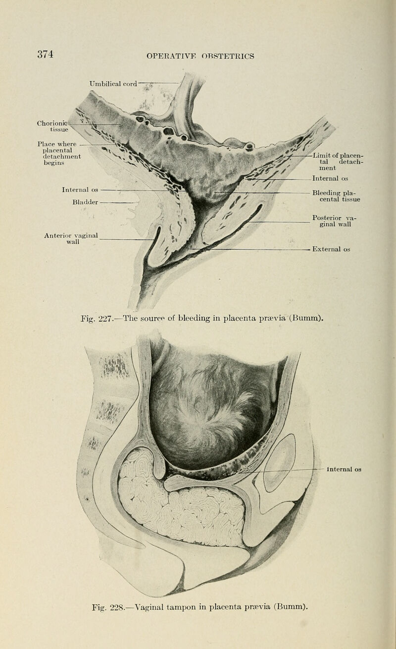 Umbilical cord Chorionic ' -Xu tissue ^ Hv- Place where ~—^ ^^*^^ placental ^\, '*\ detachment begins Anterior vaginal wall ^^-^ —Limit of plaeen- - ^^' tal detach- ment External os Fig. 227.—The source of bleeding in placenta praevia (Bumm). Internal oa Fig. 228.—Vaginal tampon in placenta prsevia (Bumm).