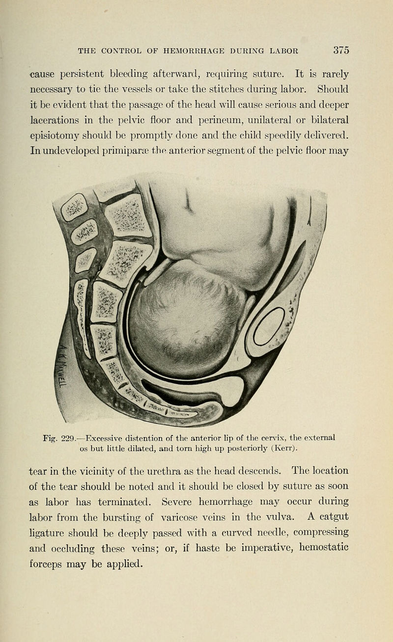cause persistent bleeding afterward, requiring suture. It is rarely necessary to tie the vessels or take the stitches during labor. Should it be evident that the passage of the head will cause serious and deeper lacerations in the pelvic floor and perineum, unilateral or bilateral episiotomy should be promptly done and the child speedily delivered. In undeveloped primiparse the anterior segment of the pelvic floor may Fig. 229.-—Excessive distention of the anterior lip of the cervix, the external OS but little dilated, and torn high up posteriorly (Kerr). tear in the vicinity of the urethra as the head descends. The location of the tear should be noted and it should be closed by suture as soon as labor has terminated. Severe hemorrhage may occur during labor from the bursting of varicose veins in the vulva. A catgut ligature should be deeply passed with a curved needle, compressing and occluding these veins; or, if haste be imperative, hemostatic forceps may be applied.
