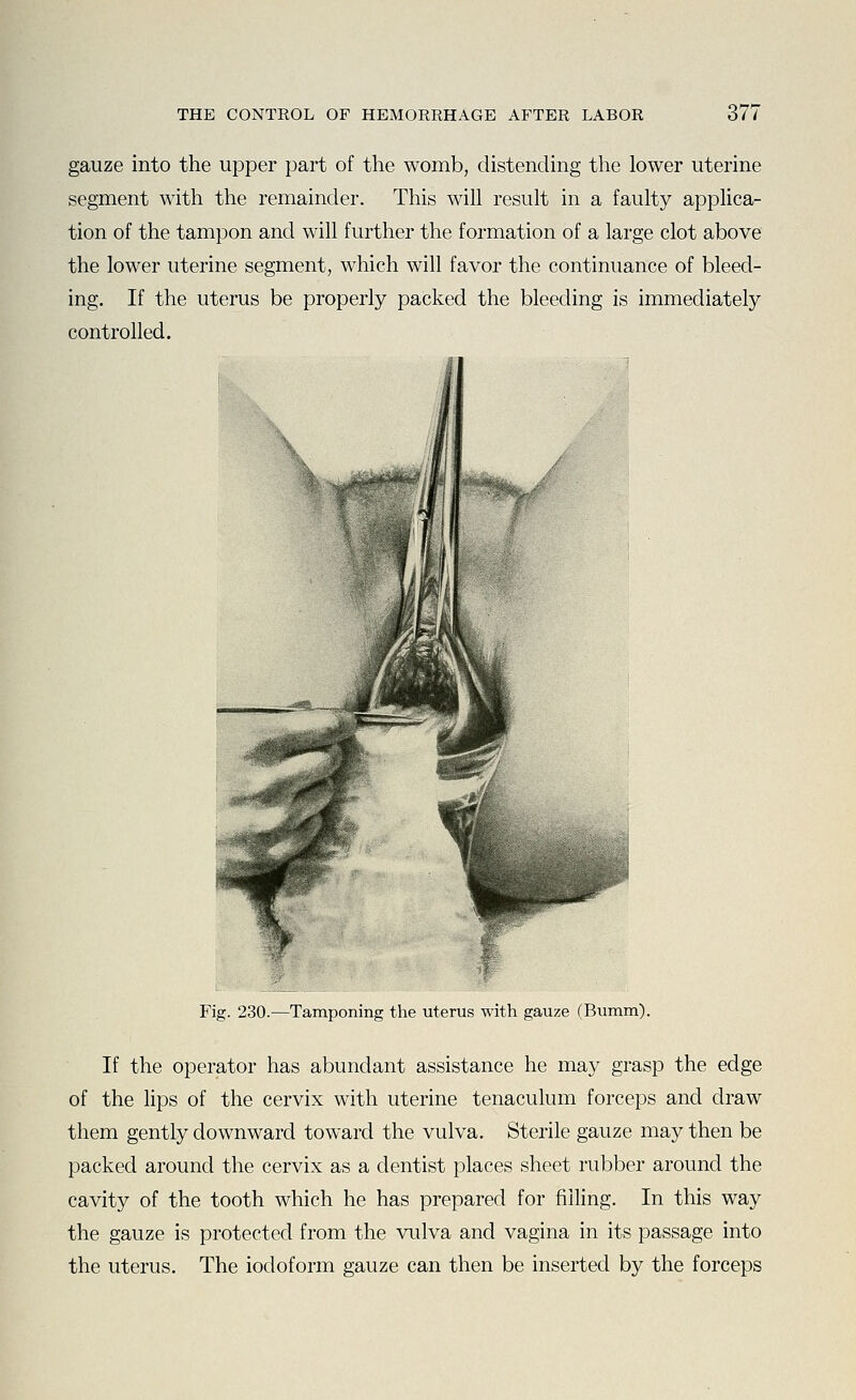 gauze into the upper part of the womb, distending the lower uterine segment with the remainder. This will result in a faulty applica- tion of the tampon and will further the formation of a large clot above the lower uterine segment, which will favor the continuance of bleed- ing. If the uterus be properly packed the bleeding is immediately controlled. / Fig. 230.—Tamponing the uterus with gauze (Bumm). If the operator has abundant assistance he may grasp the edge of the lips of the cervix with uterine tenaculum forceps and draw them gently downward toward the vulva. Sterile gauze may then be packed around the cervix as a dentist places sheet rubber around the cavity of the tooth which he has prepared for filling. In this way the gauze is protected from the vulva and vagina in its passage into the uterus. The iodoform gauze can then be inserted by the forceps