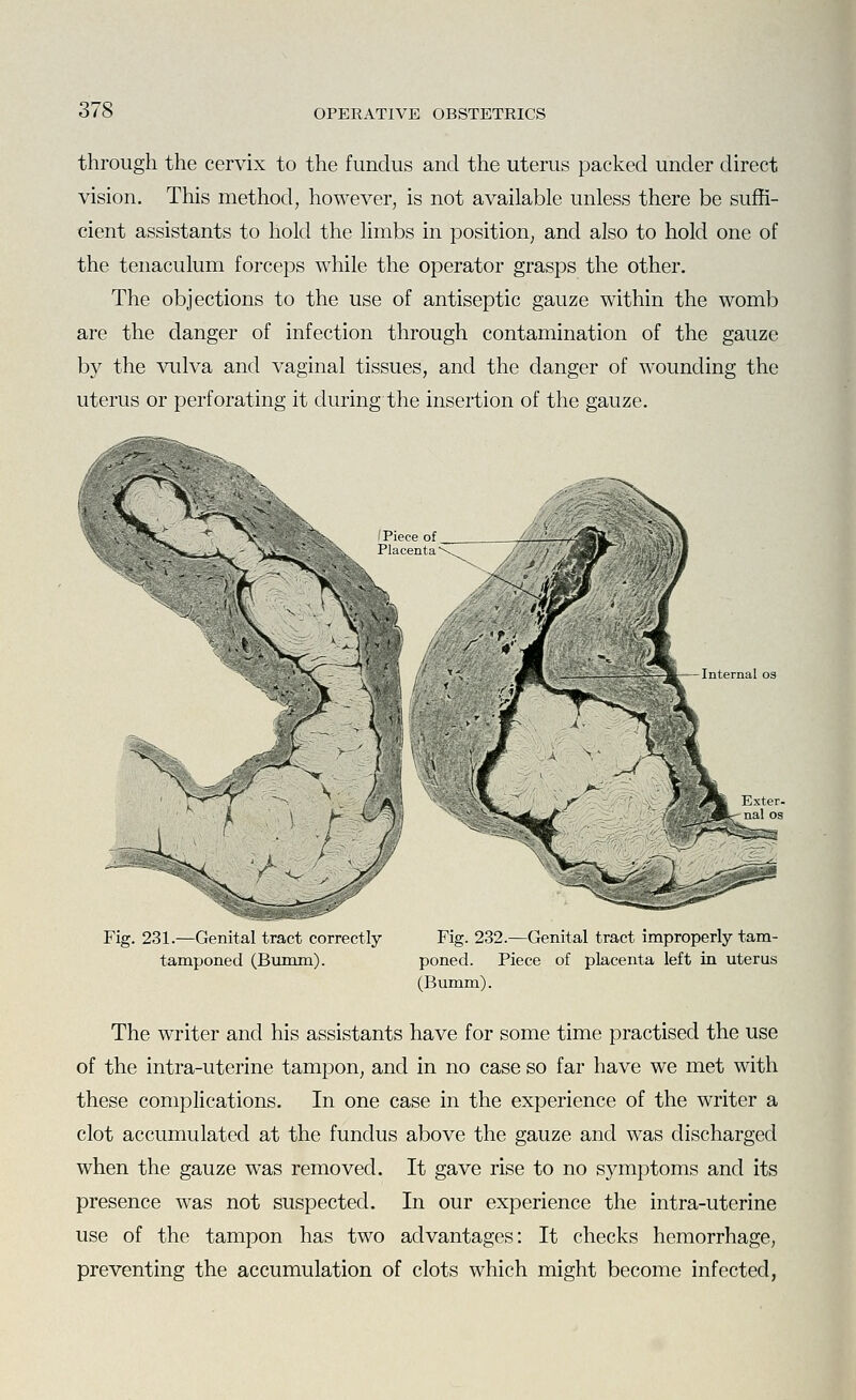 through the cervix to the fundus and the uterus packed under direct vision. This method, however, is not available unless there be suffi- cient assistants to hold the limbs in position, and also to hold one of the tenaculum forceps while the operator grasps the other. The objections to the use of antiseptic gauze within the womb are the danger of infection through contamination of the gauze by the ^ailva and vaginal tissues, and the danger of wounding the uterus or perforating it during the insertion of the gauze. Internal 03 Fig. 231.—Genital tract correctly tamponed (Bmnm). Fig. 232.—Genital tract improperly tam- poned. Piece of placenta left in uterus (Bumm). The writer and his assistants have for some time practised the use of the intra-uterine tampon, and in no case so far have we met with these complications. In one case in the experience of the writer a clot accumulated at the fundus above the gauze and was discharged when the gauze was removed. It gave rise to no symptoms and its presence was not suspected. In our experience the intra-uterine use of the tampon has two advantages: It checks hemorrhage, preventing the accumulation of clots which might become infected,