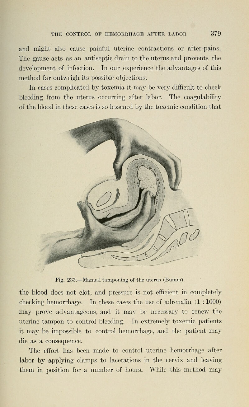 and might also cause painful uterine contractions or after-pains. The gauze acts as an antiseptic drain to the uterus and prevents the development of infection. In our experience the advantages of this method far outweigh its possible objections. In cases complicated by toxemia it may be very difficult to check bleeding from the uterus occurring after labor. The coagulability of the blood in these cases is so lessened by the toxemic condition that Fig. 233.^—Manual tamponing of the uterus (Bumm). the blood does not clot, and pressure is not efficient in completely checking hemorrhage. In these cases the use of adrenalin (1 : 1000) may prove advantageous, and it may be necessary to renew the uterine tampon to control bleeding. In extremely toxemic patients it may be impossible to control hemorrhage, and the patient may die as a consequence. The effort has been made to control uterine hemorrhage after labor by applying clamps to lacerations in the cervix and leaving them in position for a number of hours. While this method may