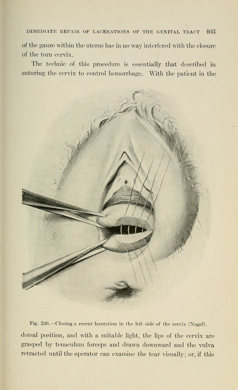 of the gauze within the uterus has in no way interfered with the closure of the torn cervix. The technic of this procedure is essentially that described in suturing the cervix to control hemorrhage. With the patient in the. Fig. 236.—Closing a recent laceration in the left side of the cervix (Nagel). dorsal position, and with a suitable light, the lips of the cervix are grasped by tenaculum forceps and drawn downward and the vulva retracted until the operator can examine the tear visually; or, if this