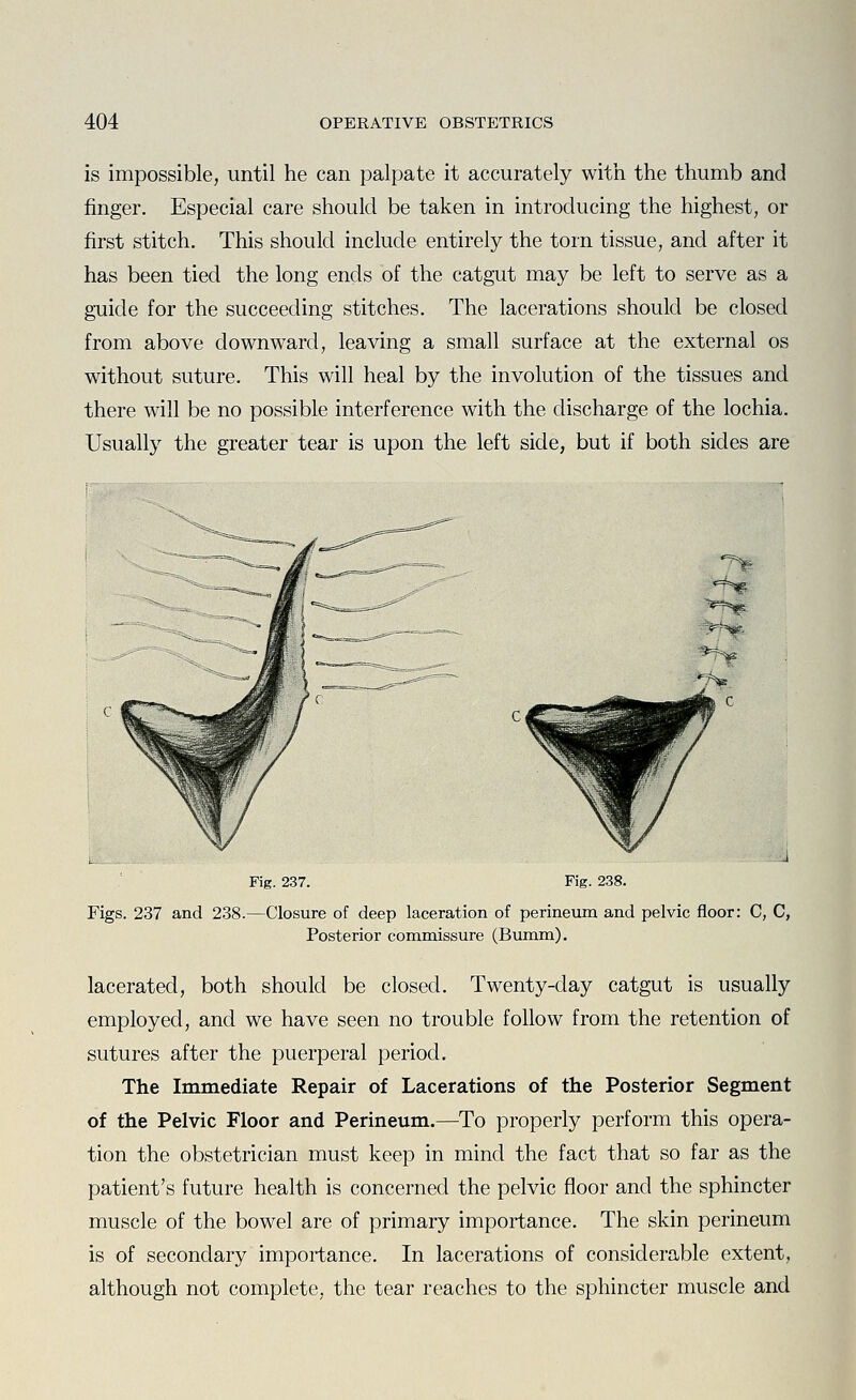 is impossible, until he can palpate it accurately with the thumb and finger. Especial care should be taken in introducing the highest, or first stitch. This should include entirely the torn tissue, and after it has been tied the long ends of the catgut may be left to serve as a gTiide for the succeeding stitches. The lacerations should be closed from above downward, leaving a small surface at the external os without suture. This will heal by the involution of the tissues and there will be no possible interference with the discharge of the lochia. Usually the greater tear is upon the left side, but if both sides are Fig. 237. Fig. 238. Figs. 237 and 238.—Closure of deep laceration of perineum and pelvic floor: C, C, Posterior commissure (Bumm). lacerated, both should be closed. Twenty-day catgut is usually employed, and we have seen no trouble follow from the retention of sutures after the puerperal period. The Immediate Repair of Lacerations of the Posterior Segment of the Pelvic Floor and Perineum.—To properly perform this opera- tion the obstetrician must keep in mind the fact that so far as the patient's future health is concerned the pelvic floor and the sphincter muscle of the bowel are of primary importance. The skin perineum is of secondary importance. In lacerations of considerable extent, although not complete, the tear reaches to the sphincter muscle and