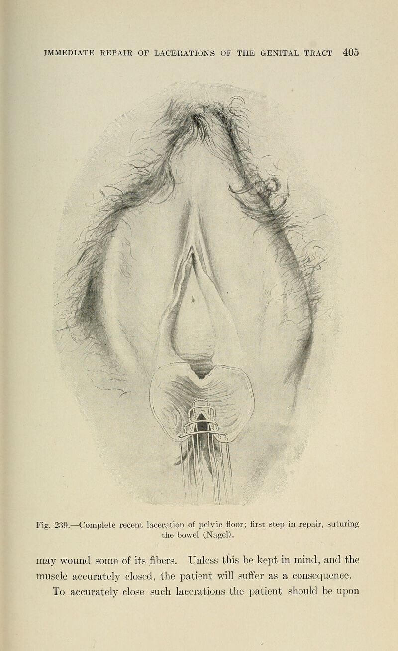 Fig. 239.—Complete recent laceration of pelvic floor; firsD step in repair, suturing the bowel (Nagel). may wound some of its fibers. Unless this be kept in mind, and the muscle accurately closed, the patient will suffer as a consequence. To accurately close such lacerations the patient should be upon