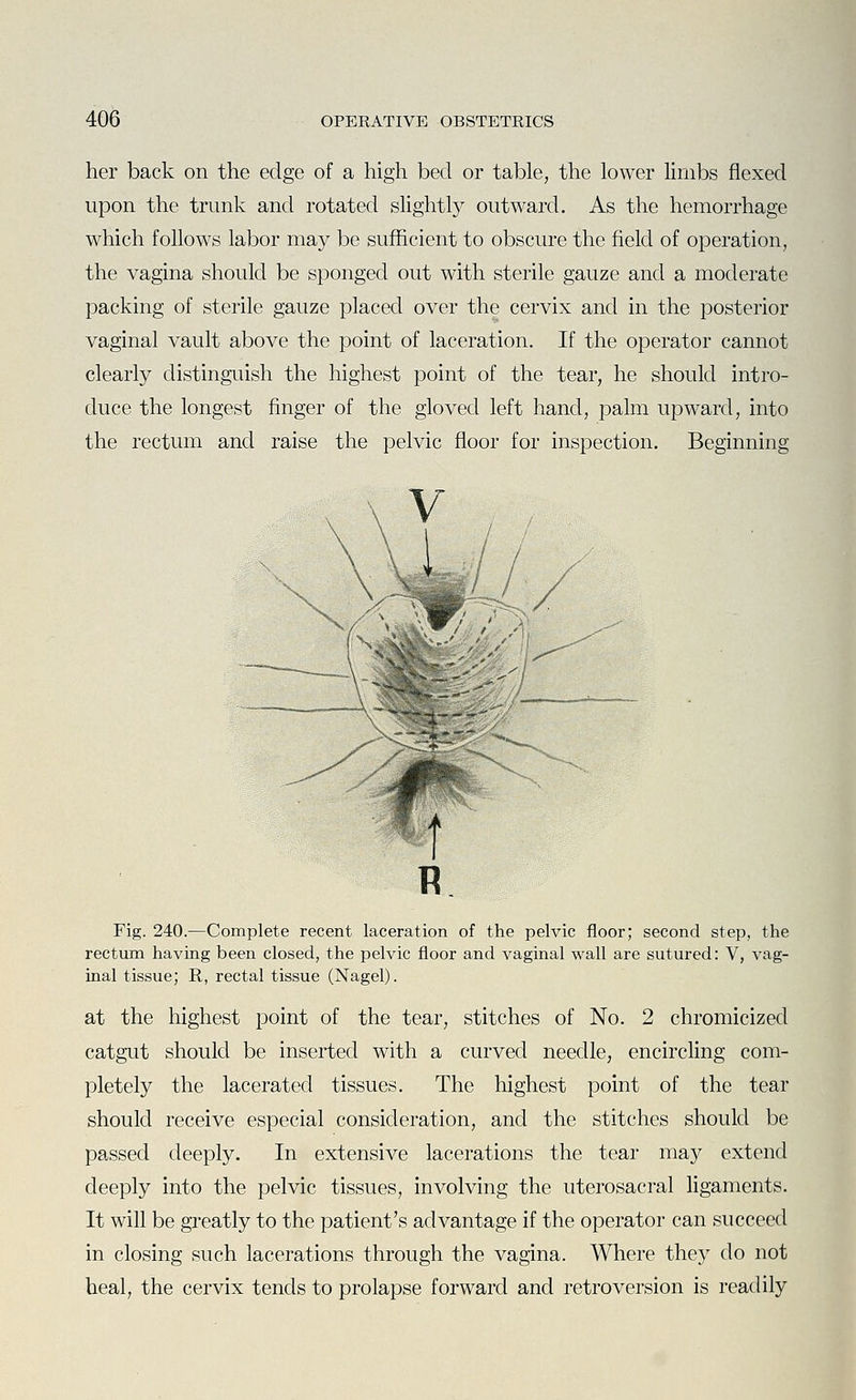 her back on the edge of a high bed or table, the lower limbs flexed upon the trunk and rotated slightly outward. As the hemorrhage which follows labor may be sufficient to obscure the field of operation, the vagina should be sponged out with sterile gauze and a moderate packing of sterile gauze placed over the cervix and in the posterior vaginal vault above the point of laceration. If the operator cannot clearly distinguish the highest point of the tear, he should intro- duce the longest finger of the gloved left hand, palm upward, into the rectum and raise the pelvic floor for inspection. Beginning Fig. 240.—Complete recent laceration of the pelvic floor; second step, the rectum having been closed, the pelvic floor and vaginal wall are sutured: V, vag- inal tissue; R, rectal tissue (Nagel). at the highest point of the tear, stitches of No. 2 chromicized catgut should be inserted with a curved needle, encircling com- pletely the lacerated tissues. The highest point of the tear should receive especial consideration, and the stitches should be passed deeply. In extensive lacerations the tear may extend deeply into the pelvic tissues, involving the uterosacral ligaments. It will be greatly to the patient's advantage if the operator can succeed in closing such lacerations through the vagina. Where they do not heal, the cervix tends to prolapse forward and retroversion is readily