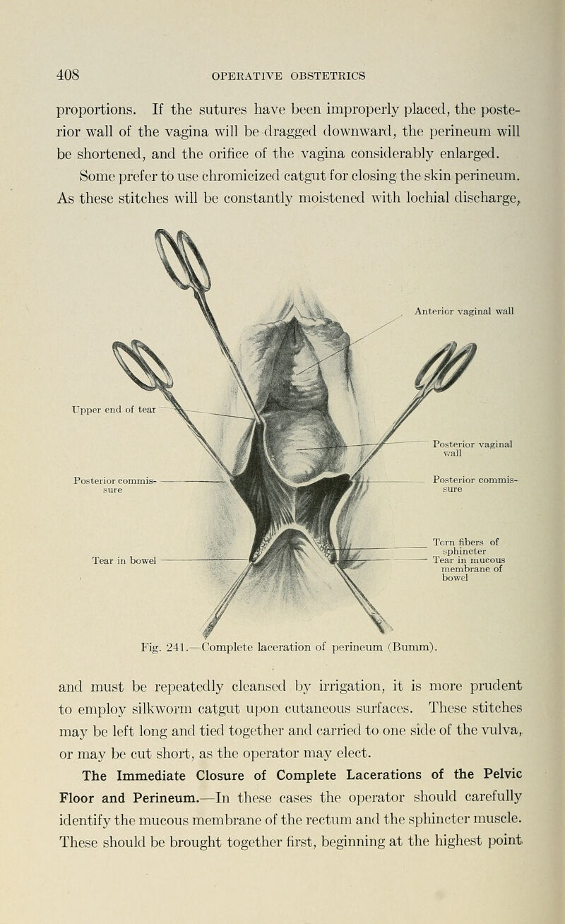 proportions. If the sutures have been improperly placed, the poste- rior wall of the vagina will be dragged downward, the perineum will be shortened, and the orifice of the vagina considerably enlarged. Some prefer to use chromicized catgut for closing the skin perineum. As these stitches will be constantly moistened with lochial discharge^ Anterior vaginal wall Upper end of tear Posterior commis- sure Tear in bowel Posterior vaginal wall Posterior commis- sure Torn fibers of sphincter Tear in mucous membrane of bowel Fig. 241.—Complete laceration of perineum (Bumm). and must be repeatedly cleansed by irrigation, it is more prudent to employ silkworm catgut upon cutaneous surfaces. These stitches may be left long and tied together and carried to one side of the vulva,, or may be cut short, as the operator may elect. The Immediate Closure of Complete Lacerations of the Pelvic Floor and Perineum.—In these cases the operator should carefully identify the mucous membrane of the rectum and the sphincter muscle. These should be brought together first, beginning at the highest point