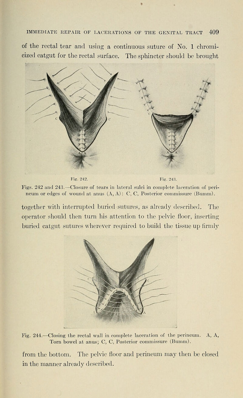 of the rectal tear and using a continuous suture of No. 1 chromi- cized catgut for the rectal surface. The sphincter should be brought Fig. 242. Fig. 243. Figs. 242 and 243.—Closure of tears in lateral sulci in complete laceration of peri- neum or edges of wound at anus (A, A): C, C, Posterior commissure (Bumm). together with interrupted buried sutures, as already described. The operator should then turn his attention to the pelvic floor, inserting buried catgut sutures wherever required to build the tissue up firmly Fig. 244.—Closing the rectal wall in complete laceration of the perineum. A, A, Torn bowel at anus; C, C, Posterior commissure (Bumm). from the bottom. The pelvic floor and perineum may then be closed in the manner already described.