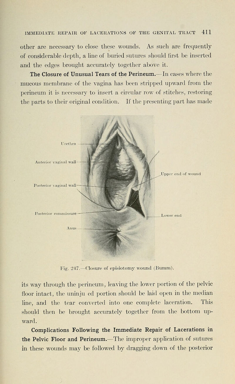 other are necessary to close these wounds. As such are frequently of considerable depth, a Une of buried sutures should first be inserted and the edges brought accurately together above it. The Closure of Unusual Tears of the Perineum.—In cases where the mucous membrane of the vagina has been stripped upward from the perineum it is necessary to insert a circular row of stitches, restoring the parts to their original condition. If the presenting part has made Urethra Anterior vaginal wall- Posterior vaginal wall—^— ^Upper end of wound _Lower end Anus Fig. 247.—Closure of episiotomy wound (Bumm). its way through the perineum, leaving the lower portion of the pelvic floor intact, the uninju ed portion should be laid open in the median line, and the tear converted into one complete laceration. This should then be brought accurately together from the bottom up- ward. Complications Following the Immediate Repair of Lacerations in the Pelvic Floor and Perineum.—The improper application of sutures in these wounds may be followed by dragging down of the posterior