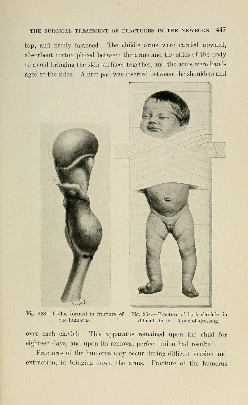 top, and firmly fastened. The cliild's. arms were carried upward, absorbent cotton placed between the arms and the sides of the body to avoid bringing the skin surfaces together, and the arms were band- aged to the sides. A firm pad was inserted between the shoulders and Fig. 253.—Callus formed in fracture of the humerus. Fig. 254.—Fracture of both clavicles in difficult birth. Mode of dressing. over each clavicle This apparatus remained upon the child for eighteen days, and upon its removal perfect union had resulted. Fractures of the humerus may occur during difficult version and extraction, in bringing down the arms. Fracture of the humerus