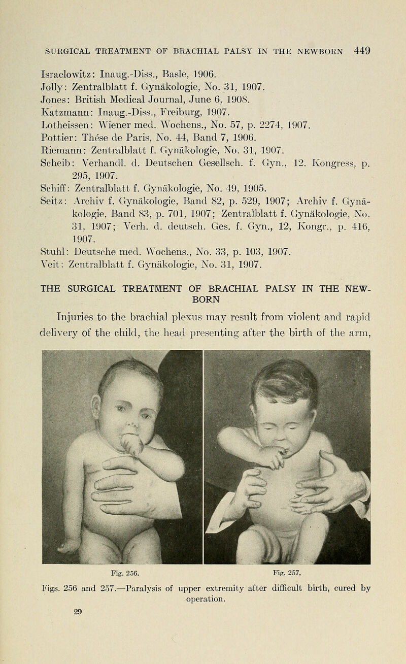 Israelowitz: Inaug.-Diss., Basle, 1906. Jolly: Zentralblatt f. Gynakologie, No. 31, 1907. Jones: British Medical Journal, June 6, 1908. Katzmann: Inaug.-Diss., Freiburg, 1907. Lotheissen: Wiener mecl. Wochens., No. 57, p. 2274, 1907. Pottier: These de Paris, No. 44, Band 7, 1906. Riemann: Zentralblatt f. Gynakologie, No. 31, 1907. Scheib: Verhandl. d. Deutschen Gesellsch. f. Gyn., 12. Kongress, p. 295, 1907. Schiff: Zentralblatt f. Gynakologie, No. 49, 1905. Seitz: Archiv f. Gynakologie, Band 82, p. 529, 1907; Archiv f. Gyna- kologie, Band 83, p. 701, 1907; Zentralblatt f. Gynakologie, No. 31, 1907; Verh. d. deutsch. Ges. f. Gyn., 12, Kongr., p. 416, 1907. Stuhl: Deutsche med. Wochens., No. 33, p. 103, 1907. Veit: Zentralblatt f. Gynakologie, No. 31, 1907. THE SURGICAL TREATMENT OF BRACHIAL PALSY IN THE NEW- BORN Injuries to the brachial plexus may result from violent and rapid delivery of the child, the head presenting after the birth of the arm, Fig. 256. Fig. 257. Figs. 256 and 257.—Paralysis of upper extremity after difficult birth, cured by operation. 29
