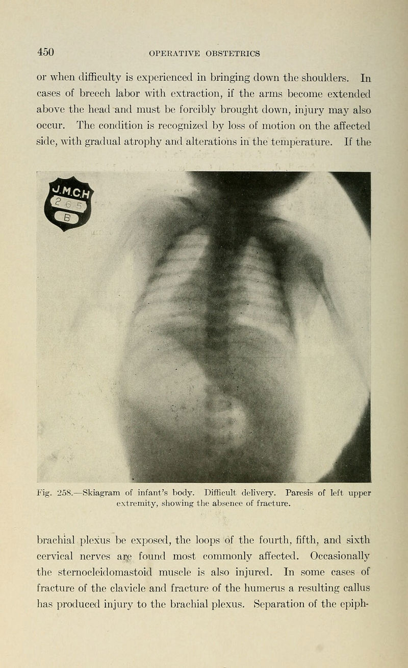 or when difficult}'' is experienced in bringing down the shoulders. In cases of breech labor with extraction, if the arms become extended above the head and must be forcibly brought clown, injury may also occur. The condition is recognized by loss of motion on the affected side, with gradual atrophy and alterations in the temperature. If the :.f|-'- JiT '£ Fig. 258.—Skiagram of infant's body. Difficult delivery. Paresis of left upper extremity, showing the absence of fracture. brachial plexus be exposed, the loops of the fourth, fifth, and sixth cervical nerves arje found most commonly affected. Occasionally the sternocleidomastoid muscle is also injured. In some cases of fracture of the clavicle and fracture of the humerus a resulting callus has produced injury to the brachial plexus. Separation of the epiph-
