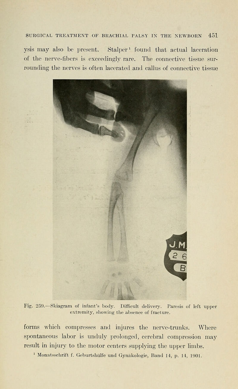 ysis may also be present. Stalper^ found that actual laceration of the nerve-fibers is exceedingly rare. The connective tissue sur- rounding the nerves is often lacerated and callus of connective tissue Fig. 259.—Skiagram of infant's body. Difficult delivery. Paresis of left upper extremity, showing the absence of fracture. forms which compresses and injures the nerve-trunks. Where spontaneous labor is unduly prolonged, cerebral compression may result in injury to the motor centers supplying the upper limbs. ^ Monatsschrift f. Geburtshulfe und Gynakologie, Band 14, p. 14, 1901.