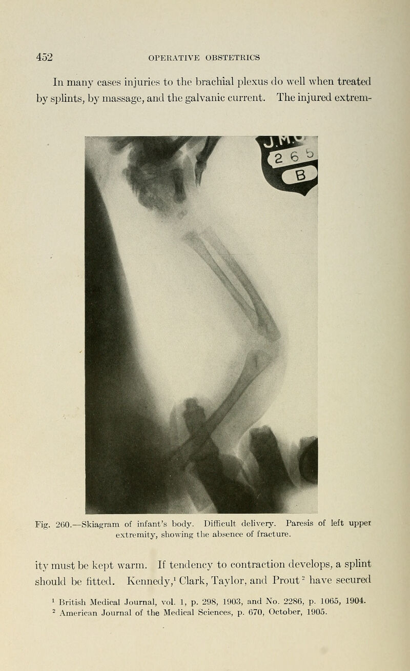 In many cases injuries to the brachial plexus do well when treated by splintS; by massage, and the galvanic current. The injured extrem- Fig. 260.—Skiagram of infant's body. Difficult delivery. Paresis of left upper extremity, showing the absence of fracture. ity must be kept warm. If tendency to contraction develops, a splint should be fitted. Kennedy,^ Clark, Taylor, and Prout' have secured 1 British Medical Journal, vol. 1, p. 298, 1903, and No. 2286, p. 1065, 1904. ^ American Journal of the Medical Sciences, p. 670, October, 1905.