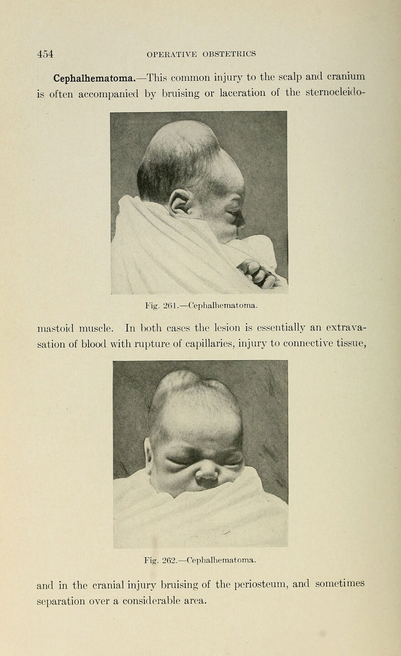 Cephalhematoma.—This common injury to the scalp and cranium is often accompanied by bruising or laceration of the sternocleido- Fig. 261.—Cephalhematoma. mastoid muscle. In both cases the lesion is essentially an extrava- sation of blood with rupture of capillaries, injury to connective tissue, Fig. 262.—Cephalhematoma. and in the cranial injury bruising of the periosteum, and sometimes separation over a considerable area.