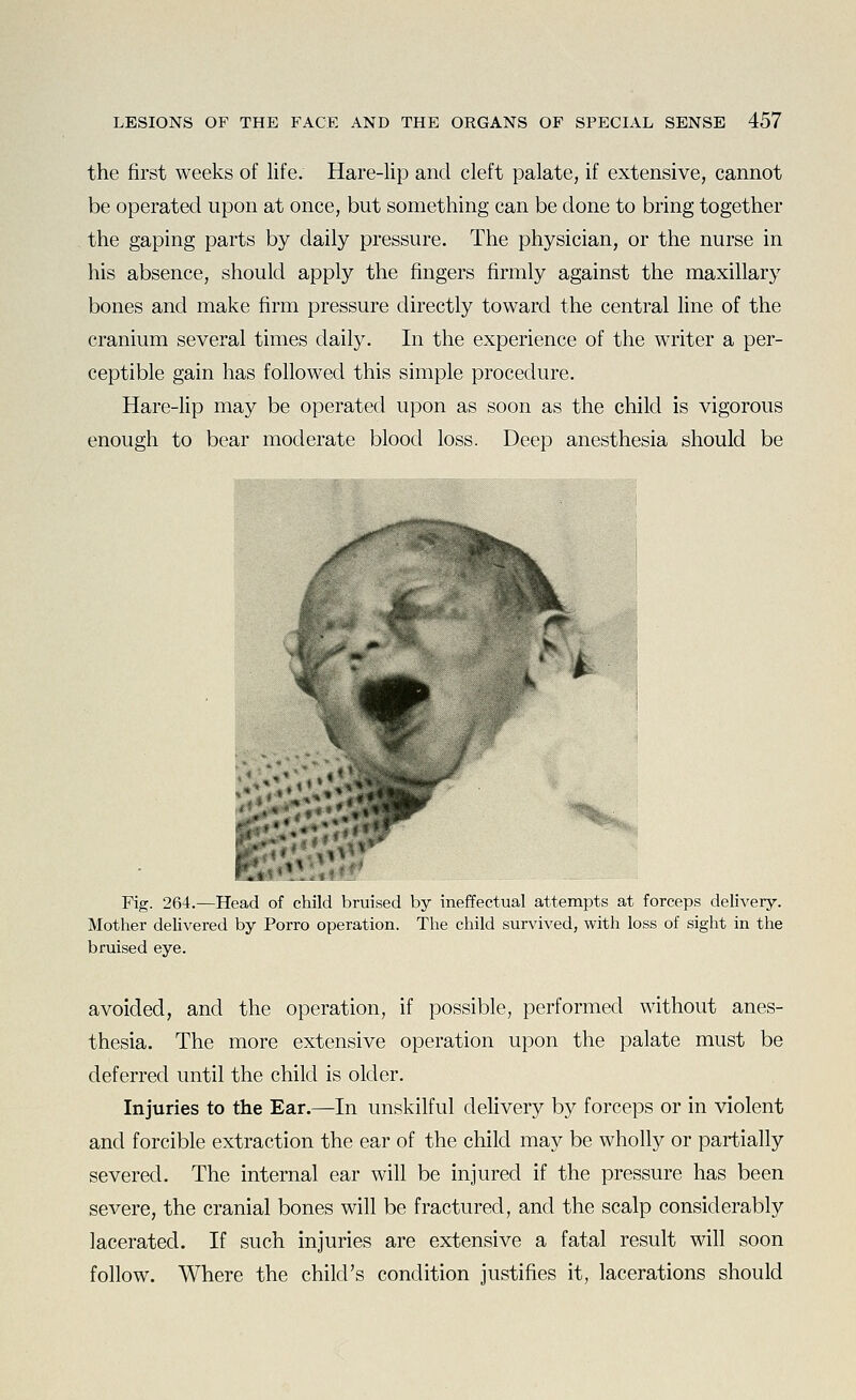 the first weeks of life. Hare-lip and cleft palate, if extensive, cannot be operated upon at once, but something can be done to bring together the gaping parts by daily pressure. The physician, or the nurse in his absence, should apply the fingers firmly against the maxillary bones and make firm pressure directly toward the central fine of the cranium several times daily. In the experience of the writer a per- ceptible gain has followed this simple procedure. Hare-lip may be operated upon as soon as the child is vigorous enough to bear moderate blood loss. Deep anesthesia should be Fig. 264.—Head of child bruised by ineffectual attempts at forceps delivery. Mother deUvered by Porro operation. The child survived, with loss of sight in the bruised eye. avoided, and the operation, if possible, performed without anes- thesia. The more extensive operation upon the palate must be deferred until the child is older. Injuries to the Ear.—In unskilful delivery by forceps or in violent and forcible extraction the ear of the child may be wholly or partially severed. The internal ear will be injured if the pressure has been severe, the cranial bones will be fractured, and the scalp considerably lacerated. If such injuries are extensive a fatal result will soon follow. Where the child's condition justifies it, lacerations should