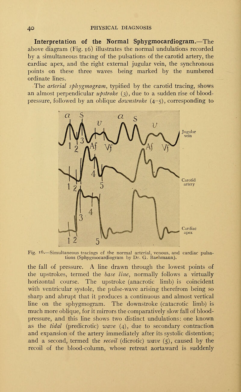 Interpretation of the Normal Sphygmocardiogram.—The above diagram (Fig. 16) illustrates the normal undulations recorded by a simultaneous tracing of the pulsations of the carotid artery, the cardiac apex, and the right external jugular vein, the synchronous points on these three waves being marked by the numbered ordinate lines. The arterial sphygmogram, typified by the carotid tracing, shows an almost perpendicular upstroke (3), due to a sudden rise of blood- pressure, followed by an oblique downstroke (4-5), corresponding to a s a mv^Aj' Fig. 16—Simultaneous tracings cf the normal arterial, venous, and cardiac pulsa- tions (Sphygmocardiogram by Dr. G. Baahmann). the fall of pressure. A line drawn through the lowest points of the upstrokes, termed the base line, normally follows a virtually horizontal course. The upstroke (anacrotic limb) is coincident with ventricular systole, the pulse-wave arising therefrom being so sharp and abrupt that it produces a continuous and almost vertical line on the sphygmogram. The downstroke (catacrotic limb) is much more oblique, for it mirrors the comparatively slow fall of blood- pressure, and this line shows two distinct undulations: one known as the tidal (predicrotic) wave (4), due to secondary contraction and expansion of the artery immediately after its systolic distention; and a second, termed the recoil (dicrotic) wave (5), caused by the recoil of the blood-column, whose retreat aortaward is suddenly