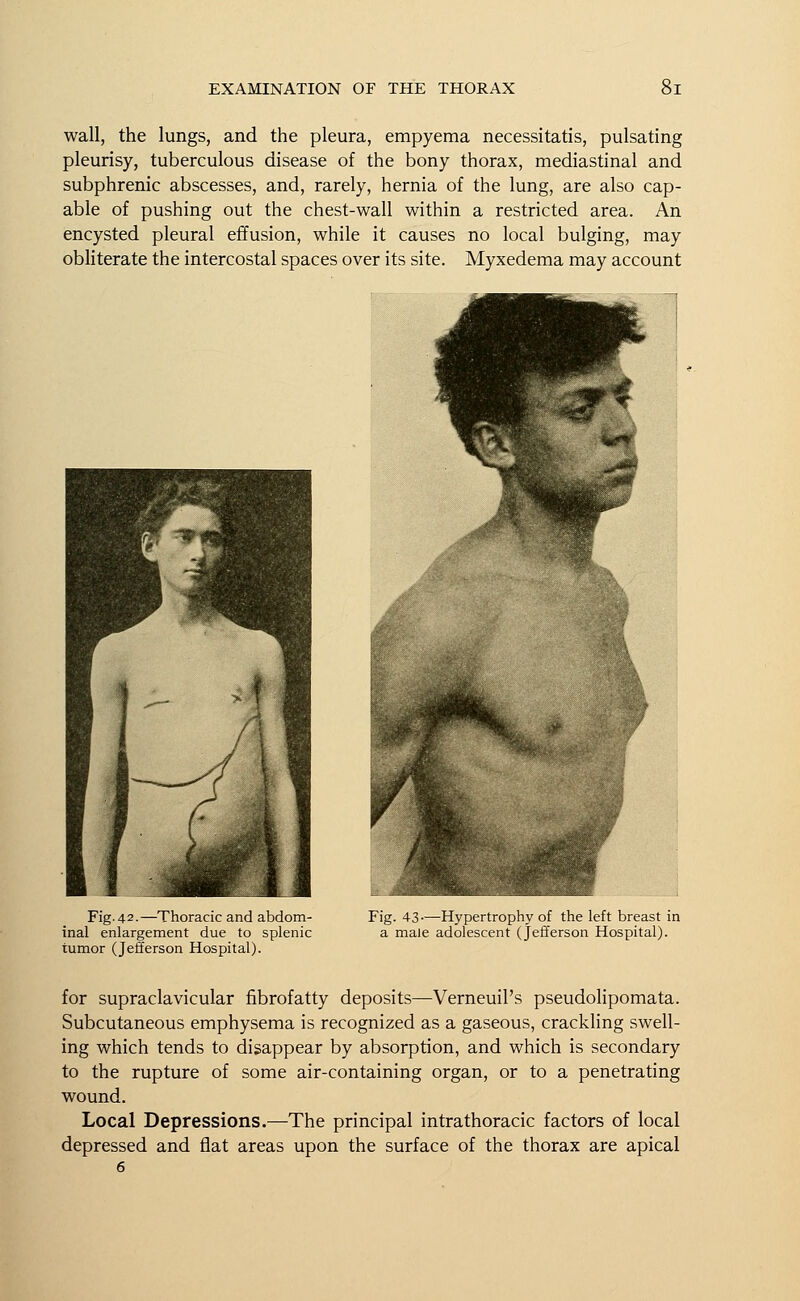 wall, the lungs, and the pleura, empyema necessitatis, pulsating pleurisy, tuberculous disease of the bony thorax, mediastinal and subphrenic abscesses, and, rarely, hernia of the lung, are also cap- able of pushing out the chest-wall within a restricted area. An encysted pleural effusion, while it causes no local bulging, may obliterate the intercostal spaces over its site. Myxedema may account Fig. 42.—Thoracic and abdom- inal enlargement due to splenic tumor (Jefferson Hospital). Fig. 43—Hypertrophy of the left breast in a male adolescent (Jefferson Hospital). for supraclavicular fibrofatty deposits—Verneuil's pseudolipomata. Subcutaneous emphysema is recognized as a gaseous, crackling swell- ing which tends to disappear by absorption, and which is secondary to the rupture of some air-containing organ, or to a penetrating wound. Local Depressions.—The principal intrathoracic factors of local depressed and flat areas upon the surface of the thorax are apical 6