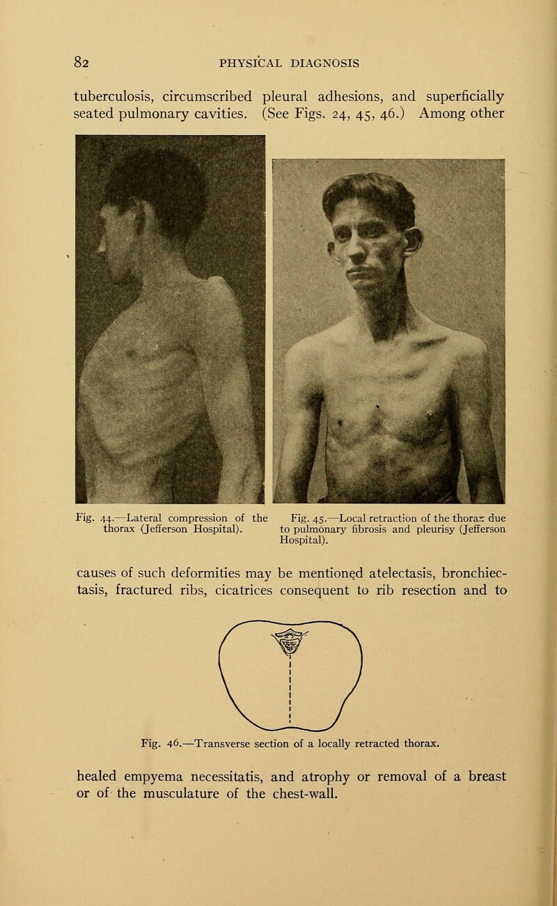 tuberculosis, circumscribed pleural adhesions, and superficially seated pulmonary cavities. (See Figs. 24, 45, 46.) Among other Fig. 44.—Lateral compression of the Fig. 45.—Local retraction of the thorax due thorax {Jefferson Hospital). to pulmonary fibrosis and pleurisy (Jefferson Hospital). causes of such deformities may be mentioned atelectasis, bronchiec- tasis, fractured ribs, cicatrices consequent to rib resection and to Fig. 46.—Transverse section of a locally retracted thorax. healed empyema necessitatis, and atrophy or removal of a breast or of the musculature of the chest-wall.