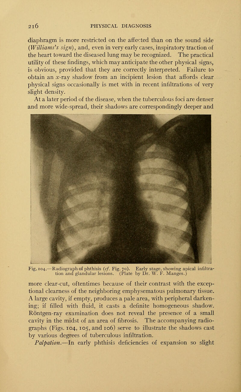 diaphragm is more restricted on the affected than on the sound side (Williams's sign), and, even in very early cases, inspiratory traction of the heart toward the diseased lung may be recognized. The practical utility of these findings, which may anticipate the other physical signs, is obvious, provided that they are correctly interpreted. Failure to obtain an x-ray shadow from an incipient lesion that affords clear physical signs occasionally is met with in recent infiltrations of very slight density. At a later period of the disease, when the tuberculous foci are denser and more wide-spread, their shadows are correspondingly deeper and Fig. 104.—Radiograph of phthisis (cf. Fig. 70). Early stage, showing apical infiltra- tion and glandular lesions. (Plate by Dr. W. F. Manges.) more clear-cut, oftentimes because of their contrast with the excep- tional clearness of the neighboring emphysematous pulmonary tissue. A large cavity, if empty, produces a pale area, with peripheral darken- ing; if filled with fluid, it casts a definite homogeneous shadow. Rontgen-ray examination does not reveal the presence of a small cavity in the midst of an area of fibrosis. The accompanying radio- graphs (Figs. 104, 105, and 106) serve to illustrate the shadows cast by various degrees of tuberculous infiltration. - Palpation.—In early phthisis deficiencies of expansion so slight