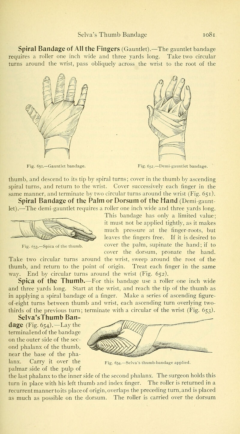 Spiral Bandage of All the Fingers (Gauntlet).—The gauntlet bandage requires a roller one inch wide and three yards long. Take two circular turns around the wrist, pass obliquely across the wrist to the root of the Fig. 651.—Gauntlet bandage. Fig. 652.—Demi-gauntlet bandage. Fig. 653.—Spica of the thumb. thumb, and descend to its tip by spiral turns; cover in the thumb by ascending spiral turns, and return to the wrist. Cover successively each finger in the same manner, and terminate by two circular turns around the wrist (Fig. 651). Spiral Bandage of the Palm or Dorsum of the Hand (Demi gaunt let).—The demi-gauntlet requires a roller one inch wide and three yards long. This bandage has only a limited value; it must not be applied tightly, as it makes much pressure at the finger-roots, but leaves the fingers free. If it is desired to cover the palm, supinate the hand; if to cover the dorsum, pronate the hand. Take two circular turns around the wrist, sweep around the root of the thumb, and return to the point of origin. Treat each finger in the same way. End by circular turns around the wrist (Fig. 652). Spica of the Thumb.—For this bandage use a roller one inch wide and three yards long. Start at the wrist, and reach the tip of the thumb as in applying a spiral bandage of a finger. Make a series of ascending figure- of-eight turns between thumb and wrist, each ascending turn overlying two- thirds of the previous turn; terminate with a circular of the wrist (Fig. 653). Selva'sThumb Ban= dage (Fig. 654),—Lay the terminal end of the bandage on the outer side of the sec- ond phalanx of the thumb, near the base of the pha- lanx. Carry it over the palmar side of the pulp of the last phalanx to the inner side of the second phalanx. The surgeon holds this turn in place with his left thumb and index finger. The roller is returned in a recurrent manner to its place of origin, overlaps the preceding turn, and is placed as much as possible on the dorsum. The roller is carried over the dorsum Fig. 654.—Selva's thumb-bandage applied.