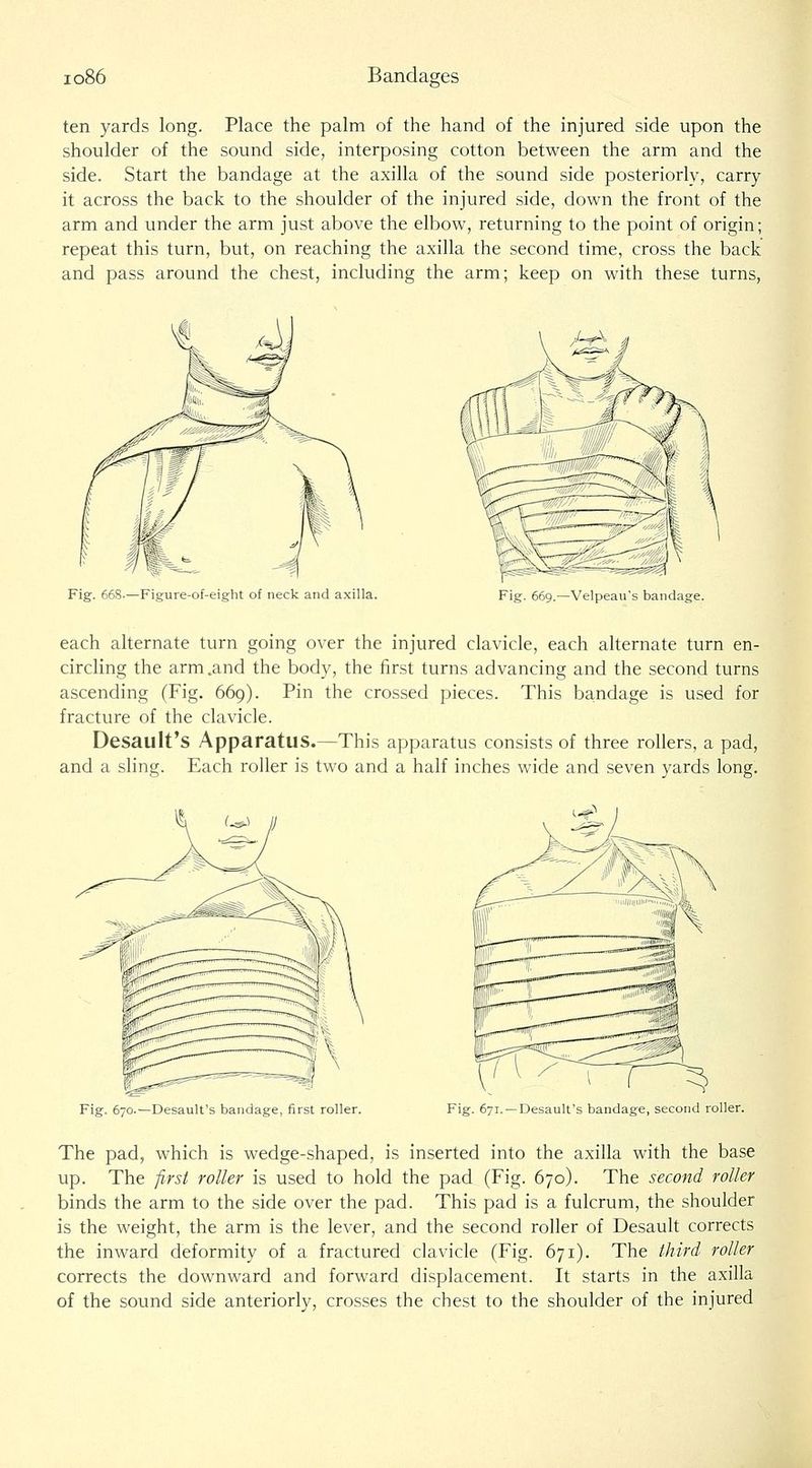 ten yards long. Place the palm of the hand of the injured side upon the shoulder of the sound side, interposing cotton between the arm and the side. Start the bandage at the axilla of the sound side posteriorly, carry it across the back to the shoulder of the injured side, down the front of the arm and under the arm just above the elbow, returning to the point of origin; repeat this turn, but, on reaching the axilla the second time, cross the back and pass around the chest, including the arm; keep on with these turns, ;/-^. Fig. 66S.—Figure-of-eight of neck and axilla. Fig. 669.—Velpeau's bandage. each alternate turn going over the injured clavicle, each alternate turn en- circling the arm .and the body, the first turns advancing and the second turns ascending (Fig. 669). Pin the crossed pieces. This bandage is used for fracture of the clavicle. Desault's Apparatus.—This apparatus consists of three rollers, a pad, and a sling. Each roller is two and a half inches wide and seven yards long. Fig. 670.—Desault's ban first roller. Fig. 671. —Desault's bandage, second roller. The pad, which is wedge-shaped, is inserted into the axilla with the base up. The first roller is used to hold the pad (Fig. 670). The second roller binds the arm to the side over the pad. This pad is a fulcrum, the shoulder is the weight, the arm is the lever, and the second roller of Desault corrects the inward deformity of a fractured clavicle (Fig. 671). The third roller corrects the downward and forward displacement. It starts in the axilla of the sound side anteriorly, crosses the chest to the shoulder of the injured