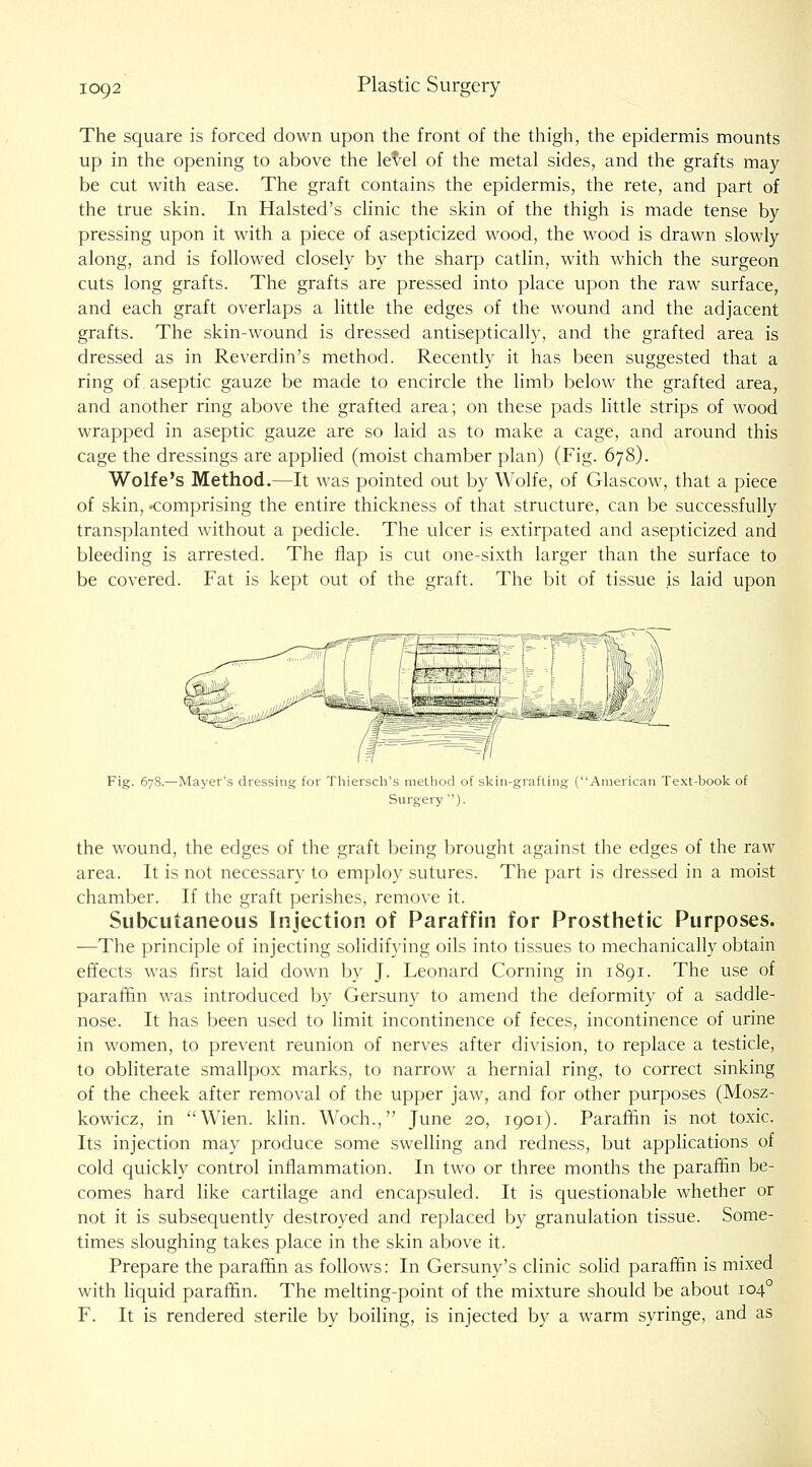 The square is forced down upon the front of the thigh, the epidermis mounts up in the opening to above the lethal of the metal sides, and the grafts may be cut with ease. The graft contains the epidermis, the rete, and part of the true skin. In Halsted's clinic the skin of the thigh is made tense by pressing upon it with a piece of asepticized wood, the wood is drawn slowly along, and is followed closely by the sharp catlin, with which the surgeon cuts long grafts. The grafts are pressed into place upon the raw surface, and each graft overlaps a little the edges of the wound and the adjacent grafts. The skin-wound is dressed antiseptically, and the grafted area is dressed as in Reverdin's method. Recently it has been suggested that a ring of aseptic gauze be made to encircle the limb below the grafted area, and another ring above the grafted area; on these pads little strips of wood wrapped in aseptic gauze are so laid as to make a cage, and around this cage the dressings are applied (moist chamber plan) (Fig. 678). Wolfe's Method.—It was pointed out by Wolfe, of Glascow, that a piece of skin, -comprising the entire thickness of that structure, can be successfully transplanted without a pedicle. The ulcer is extirpated and asepticized and bleeding is arrested. The flap is cut one-sixth larger than the surface to be covered. Fat is kept out of the graft. The bit of tissue is laid upon Fig. 678.—Mayer's dressing for Tliiersch's method of slcin-grafling (American Text-book of Surgery'). the wound, the edges of the graft being brought against the edges of the raw area. It is not necessary to employ sutures. The part is dressed in a moist chamber. If the graft perishes, remove it. Subcutaneous Injection of Paraffin for Prosthetic Purposes. —The principle of injecting solidifying oils into tissues to mechanically obtain effects was first laid down by J. Leonard Corning in 1891. The use of paraffin was introduced by Gersuny to amend the deformity of a saddle- nose. It has been used to limit incontinence of feces, incontinence of urine in women, to prevent reunion of nerves after division, to replace a testicle, to obliterate smallpox marks, to narrow a hernial ring, to correct sinking of the cheek after removal of the upper jaw, and for other purposes (Mosz- kowicz, in Wien. klin. Woch., June 20, 1901). Paraffin is not toxic. Its injection may produce some swelling and redness, but applications of cold quickly control inflammation. In two or three months the paraffin be- comes hard like cartilage and encapsuled. It is questionable whether or not it is subsequently destroyed and replaced by granulation tissue. Some- times sloughing takes place in the skin above it. Prepare the paraffin as follows: In Gersuny's clinic solid paraffin is mixed with liquid paraffin. The melting-point of the mixture should be about 104° F. It is rendered sterile by boiling, is injected by a warm syringe, and as