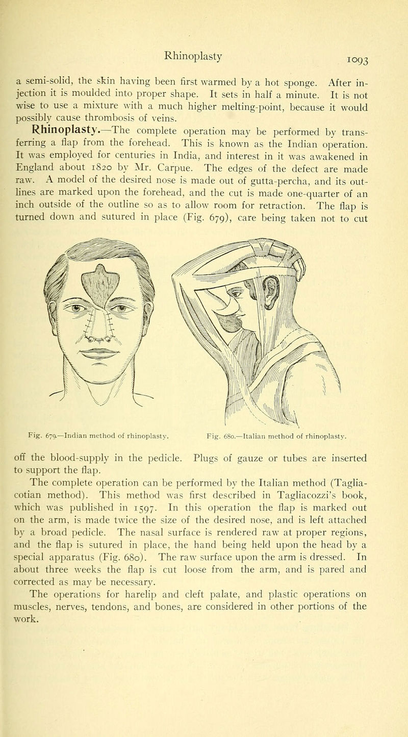 Rhinoplasty 1093 a semi-solid, the skin having been first warmed by a hot sponge. After in- jection it is moulded into proper shape. It sets in half a minute. It is not wise to use a mixture with a much higher melting-point, because it would possibly cause thrombosis of veins. Rhinoplasty.—The complete operation may be performed by trans- ferring a flap from the forehead. This is known as the Indian operation. It was employed for centuries in India, and interest in it was awakened in England about 1820 by Mr. Carpue. The edges of the defect are made raw. A model of the desired nose is made out of gutta-percha, and its out- lines are marked upon the forehead, and the cut is made one-quarter of an inch outside of the outline so as to allow room for retraction. The flap is turned down and sutured in place (Fig. 679), care being taken not to cut Fig. 679.—Indian method of rhinoplasty. Fig. 680.—Italian method of rhinoplast}'. off the blood-supply in the pedicle. Plugs of gauze or tubes are inserted to support the flap. The complete operation can be performed by the Itahan method (Taglia- cotian method). This method was first described in Taghacozzi's book, which was published in 1597. In this operation the flap is marked out on the arm, is made twice the size of the desired nose, and is left attached by a broad pedicle. The nasal surface is rendered raw at proper regions, and the flap is sutured in place, the hand being held upon the head by a special apparatus (Fig. 680). The raw surface upon the arm is dressed. In about three weeks the flap is cut loose from the arm, and is pared and corrected as may be necessary. The operations for harelip and cleft palate, and plastic operations on muscles, nerves, tendons, and bones, are considered in other portions of the work.