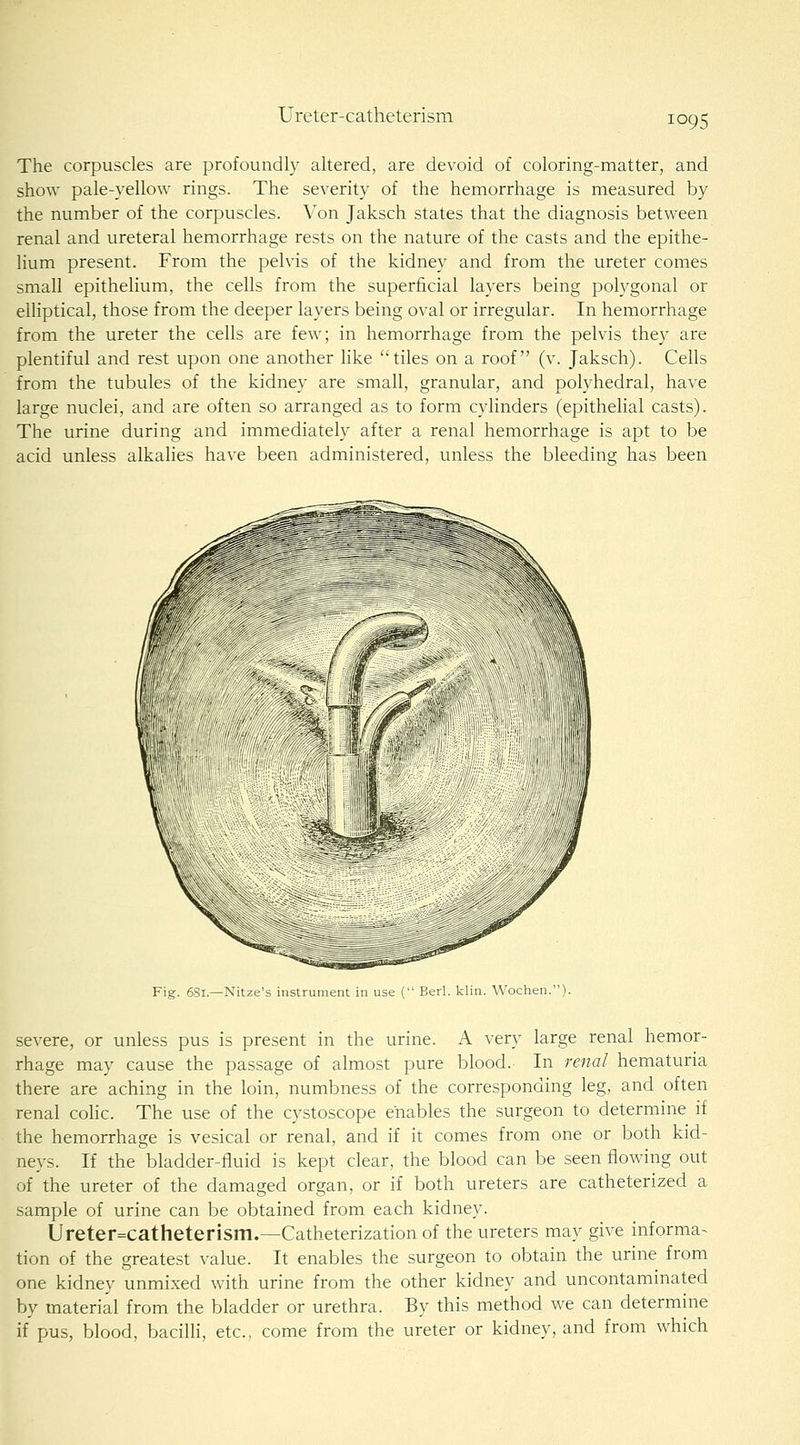 Ureter-catheterism The corpuscles are profoundly altered, are devoid of coloring-matter, and show pale-yellow rings. The severity of the hemorrhage is measured by the number of the corpuscles. Von Jaksch states that the diagnosis between renal and ureteral hemorrhage rests on the nature of the casts and the epithe- lium present. From the pelvis of the kidney and from the ureter comes small epithelium, the cells from the superficial layers being polygonal or elliptical, those from the deeper layers being oval or irregular. In hemorrhage from the ureter the cells are few; in hemorrhage from the pelvis they are plentiful and rest upon one another like tiles on a roof (v. Jaksch). Cells from the tubules of the kidney are small, granular, and polyhedral, have large nuclei, and are often so arranged as to form cylinders (epithelial casts). The urine during and immediately after a renal hemorrhage is apt to be acid unless alkahes have been administered, unless the bleeding has been Fig. 681.—Nitze's instrument in use ( Bed. klin. Wochen.). severe, or unless pus is present in the urine. A very large renal hemor- rhage may cause the passage of almost pure blood. In renal hematuria there are aching in the loin, numbness of the corresponding leg, and often renal colic. The use of the cystoscope enables the surgeon to determine if the hemorrhage is vesical or renal, and if it comes from one or both kid- neys. If the bladder-fluid is kept clear, the blood can be seen flowing out of the ureter of the damaged organ, or if both ureters are catheterized a sample of urine can be obtained from each kidney. Ureter=catheterism.—Catheterization of the ureters may give informa^ tion of the greatest value. It enables the surgeon to obtain the urine from one kidney unmixed with urine from the other kidney and uncontaminated by material from the bladder or urethra. By this method we can determhie if pus, blood, bacilli, etc., come from the ureter or kidney, and from which