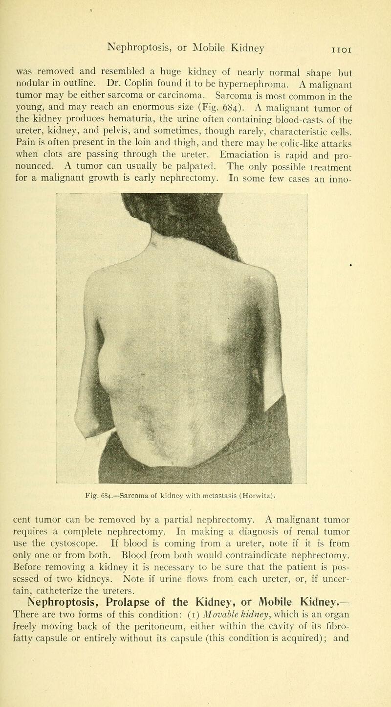 Nephroptosis, or ISIobile Kidney IIOI was removed and resembled a huge kidney of nearly normal shape but nodular in outline. Dr. Coplin found it to be hypernephroma. A malignant tumor may be either sarcoma or carcinoma. Sarcoma is most common in the young, and may reach an enormous size (Fig. 684). A malignant tumor of the kidney produces hematuria, the urine often containing blood-casts of the ureter, kidney, and pelvis, and sometimes, though rarely, characteristic ceils. Pain is often present in the loin and thigh, and there may be colic-like attacks when clots are passing through the ureter. Emaciation is rapid and pro- nounced. A tumor can usually be palpated. The only possible treatment for a maUgnant growth is early nephrectomy. In some few cases an inno- Fig. 684.—Sarcoma of kidney with metastasis (Horwitz), cent tumor can be removed by a partial nephrectomy. A malignant tumor requires a complete nephrectomy. In making a diagnosis of renal tumor use the cystoscope. If blood is coming from a ureter, note if it is from only one or from both. Blood from both would contraindicate nephrectomy. Before removing a kidney it is necessary to be sure that the patient is pos- sessed of two kidneys. Note if urine flows from each ureter, or, if uncer- tain, catheterize the ureters. Nephroptosis, Prolapse of the Kidney, or Mobile Kidney.— There are two forms of this condition: (i) Movable kidney, which is an organ freely moving back of the peritoneum, either within the cavity of its fibro- fatty capsule or entirely without its capsule (this condition is acquired); and