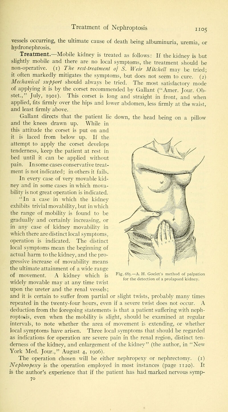 Treatment of Nephroptosis vessels occurring, the ultimate cause of death being albuminuria, uremia, or hydronephrosis. Treatment.—Mobile kidney is treated as follows: If the kidney is but shghtly mobile and there are no local symptoms, the treatment should be non-operative, (i) The rest-treatment of S. Weir Mitchell may be tried; it often markedly mitigates the symptoms, but does not seem to cure. (2) Mechanical support should always be tried. The most satisfactory mode of applying it is by the corset recommended by Gallant (Amer. Jour. Ob- stet., July, 1901). This corset is long and straight in front, and when appHed, fits firmly over the hips and lower abdomen, less firmly at the waist, and least Ih^mly above. Gallant directs that the patient he down, the head being on a pillow and the knees drawn up. While in this attitude the corset is put on and it is laced from below up. If the attempt to apply the corset develops tenderness, keep the patient at rest in bed until it can be applied without pain. In some cases conservative treat- ment is not indicated; in others it fails. In every case of very movable kid- ney and in some cases in which mova- bility is not great operation is indicated. In a case in which the kidney exhibits trivial movability, but in which the range of mobility is found to be gradually and certainly increasing, or in any case of kidney movability in which there are distinct local symptoms, operation is indicated. The distinct local symptoms mean the beginning of actual harm to the kidney, and the pro- gressive increase of movability means the ultimate attainment of a wide range of movement. A kidney which is widely movable may at any time twist upon the ureter and the renal vessels; and it is certain to suffer from partial or slight twists, probably many times repeated in the twenty-four hours, even if a severe twist does not occur. A deduction from the foregoing statements is that a patient suffering with neph- roptosis, even when the mobility is slight, should be examined at regular intervals, to note whether the area of movement is extending, or whether local symptoms have arisen. Three local symptoms that should be regarded as indications for operation are severe pain in the renal region, distinct ten- derness of the kidney, and enlargement of the kidney (the author, in New York Med. Jour., August 4, igo6). The operation chosen will be either nephropexy or nephrectomy, (i) Nephropexy is the operation employed in most instances (page 1120). It is the author's experience that if the patient has had marked nervous symp- 70 Fig. 685.—A. H. Goelet's method of palpation for the detection of a prolapsed kidney.