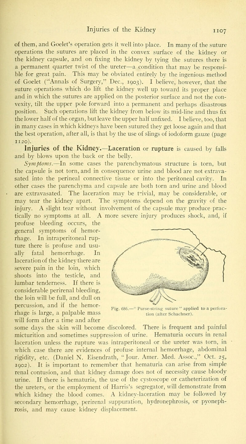 Injuries of the Kidney of them, and Goelet's operation gets it weU into place. In many of the suture operations the sutures are placed in the convex surface of the kidney or the kidney capsule, and on fixing the kidney by tying the sutures there is a permanent quarter twist of the ureter—a condition that may be responsi- ble for great pain. This may be obviated entirely by the ingenious method of Goelet (Annals of Surgery, Dec, 1903). I believe, however, that the suture operations which do lift the kidney well up toward its proper place and in which the sutures are applied on the posterior surface and not the con- vexity, tilt the upper pole forward into a permanent and perhaps disastrous position. Such operations lift the kidney from below its mid-line and thus fix the lower half of the organ, but leave the upper half unfixed. I believe, too, that in many cases in which kidneys have been sutured they get loose again and that the best operation, after all, is that by the use of slings of iodoform gauze (page 1120). Injuries of the Kidney.—Laceration or rupture is caused by falls and by blows upon the back or the belly. Symptoms.—In some cases the parenchymatous structure is torn, but the capsule is not torn, and in consequence urine and blood are not extrava- sated into the perineal connective tissue or into the peritoneal cavity. In other cases the parenchyma and capsule are both torn and urine and blood are extravasated. The laceration may be trivial, may be considerable, or may tear the kidney apart. The symptoms depend on the gravity of the injury. A slight tear without involvement of the capsule may produce prac- tically no symptoms at all. A more severe injury produces shock, and, if profuse bleeding occurs, the general symptoms of hemor- rhage. In intraperitoneal rup- ture there is profuse and usu- ally fatal hemorrhage. In laceration of the kidney there are severe pain in the loin, which shoots into the testicle, and lumbar tenderness. If there is considerable perirenal bleeding, the loin will be full, and dull on percussion, and if the hemor- rhage is large, a palpable mass will form after a time and after some days the skin will become discolored. There is frequent and painful micturition and sometimes suppression of urine. Hematuria occurs in renal laceration unless the rupture was intraperitoneal or the ureter was torn, in which case there are evidences of profuse internal hemorrhage, abdominal rigidity, etc. (Daniel N. Eisendrath, Jour. Amer. Med. Assoc, Oct. 25, 1902). It is important to remember that hematuria can arise from simple renal contusion, and that kidney damage does not of necessity cause bloody urine. If there is hematuria, the use of the cystoscope or catheterization of the ureters, or the employment of Harris's segregator, will demonstrate from which kidney the blood comes. A kidney-laceration may be followed by secondary hemorrhage, perirenal suppuration, hydronephrosis, or pyoneph- rosis, and may cause kidney displacement. Fig. 686.— Purse-string suture  applied to a perfora- tion (after Sciiachner).