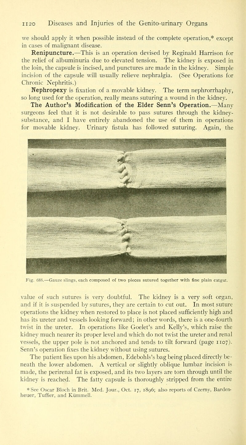 we should apply it when possible instead of the complete operation,* except in cases of malignant disease. Renipuncture.—This is an operation devised by Reginald Harrison for the relief of albuminuria due to elevated tension. The kidney is exposed in the loin, the capsule is incised, and punctures are made in the kidney. Simple incision of the capsule will usually relieve nephralgia. (See Operations for Chronic Nephritis.) Nephropexy is fixation of a movable kidney. The term nephrorrhaphy, BO long used for the operation, really means suturing a wound in the kidney. The Author's Modification of the Elder Senn's Operation.—Many surgeons feel that it is not desirable to pass sutures through the kidney- substance, and I have entirely abandoned the use of them in operations for movable kidney. Urinary fistula has followed suturing. Again, the Fig. 688.—Gauze slings, each composed of two pieces sutured together with fine plain catgut. value of such sutures is very doubtful. The kidney is a very soft organ, and if it is suspended by sutures, they are certain to cut out. In most suture operations the kidney when restored to place is not placed sufficiently high and has its ureter and vessels looking forward; in other words, there is a one-fourth twist in the ureter. In operations like Goelet's and Kelly's, which raise the kidney much nearer its proper level and which do not twist the ureter and renal vessels, the upper pole is not anchored and tends to tilt forward (page 1107). Senn's operation fixes the kidney without using sutures. The patient lies upon his abdomen, Edebohls's bag being placed directly be- neath the lower abdomen. A vertical or slightly oblique lumbar incision is made, the perirenal fat is exposed, and its two layers are torn through until the kidney is reached. The fatty capsule is thoroughly stripped from the entire * See Oscar Bloch in Brit. Med. Jour., Oct. 17, 1896; also reports of Czemy, Barden- heuer, Tuffier, and Kiimmell.