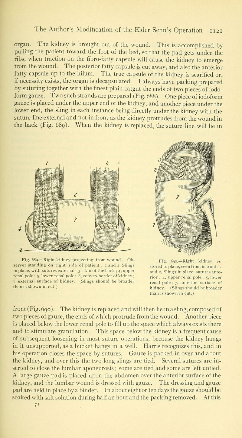 organ. The kidney is brought out of the wound. This is accomplished by pulling the patient toward the foot of the bed, so that the pad gets under the ribs, when traction on the fibro-fatty capsule will cause the kidney to emerge from the wound. The posterior fatty capsule is cut away, and also the anterior fatty capsule up to the hilum. The true capsule of the kidney is scarified or, if necessity exists, the organ is decapsulated. I always have packing prepared by suturing together with the finest plain catgut the ends of two pieces of iodo- form gauze. Two such strands are prepared (Fig. 688). One piece of iodoform gauze is placed under the upper end of the kidney, and another piece under the lower end, the sling in each instance being directly under the kidney with the suture line external and not in front as the kidney protrudes from the wound in the back (Fig. 689). When the kidney is replaced, the suture line will lie in Fig. 689.—Right kidney projecting from wound. Ob- server standing on right side of patient: i and 2, Slings in place, with sutures external; 3, skin of the back ; 4, upper renal pole ; 5, lower renal pole ; 6, convex border of kidney; 7, external surface of kidney. (Slings should be broader than is shown in cut.) Fig.. 690.—Right kidney ro stored to place, seen from in front: > and 2, Slings in place, sutures ante- rior ; 4, upper renal pole ; 5, lower renal pole; 7, anterior surface of kidney. (Slings should be broader than is sljown in cut.) front (Fig. 690). The kidney is replaced and will then lie in a sling, composed of two pieces of gauze, the ends of which protrude from the wound. Another piece is placed below the lower renal pole to fill up the space which always exists there and to stimulate granulation. This space below the kidney is a frequent cause of subsequent loosening in most suture operations, because the kidney hangs in it unsupported, as a bucket hangs in a well. Harris recognizes this, and in his operation closes the space by sutures. Gauze is packed in over and about the kidney, and over this the two long slings are tied. Several sutures are in- serted to close the lumbar aponeurosis; some are tied.and some are left untied. A large gauze pad is placed upon the abdomen over the anterior surface of the kidney, and the lumbar wound is dressed with gauze. The dressing and gauze pad are held in place by a binder. In about eight or ten days the gauze should be soaked with salt solution during half an hour and the packing removed. At this 71