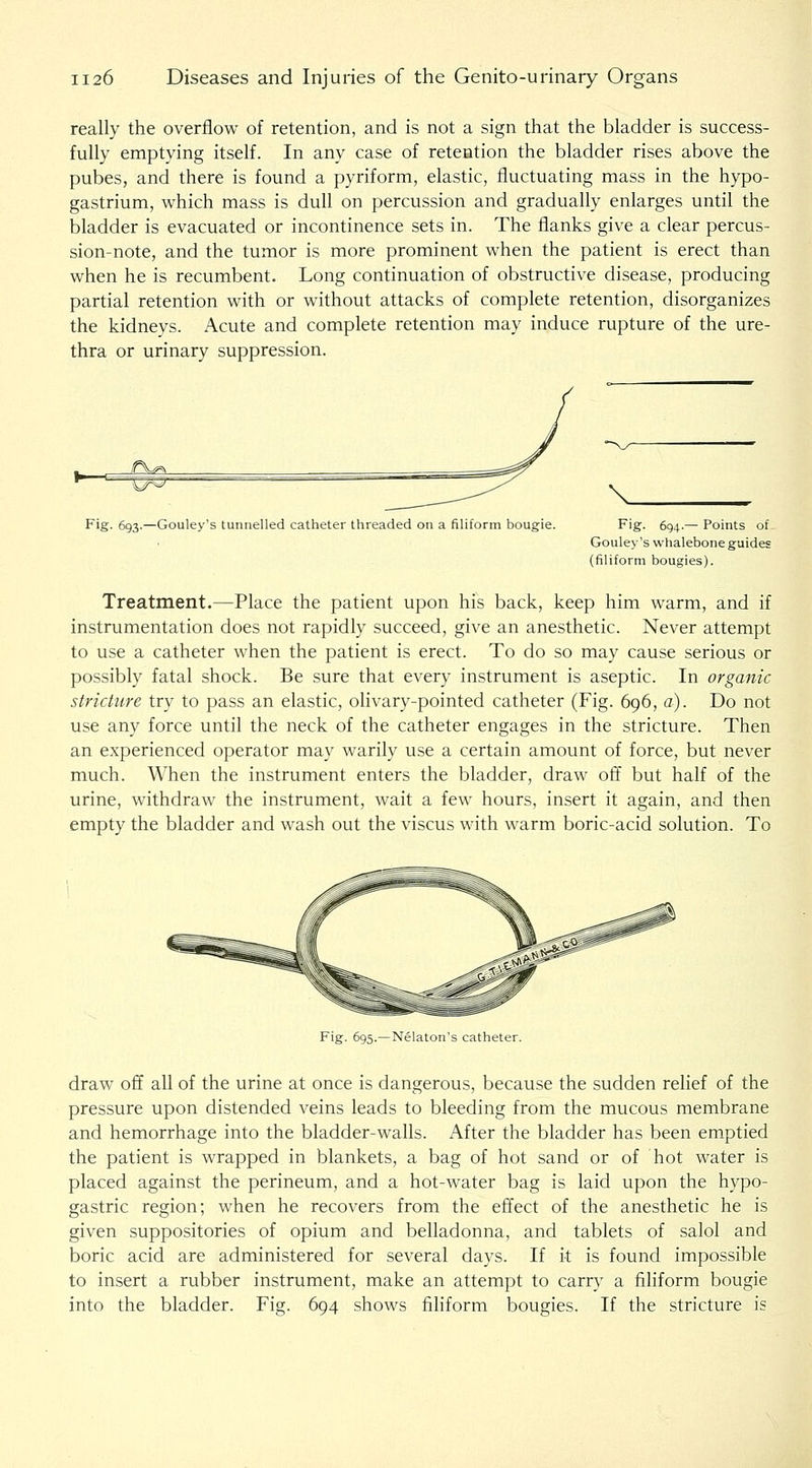 really the overflow of retention, and is not a sign that the bladder is success- fully emptying itself. In any case of retention the bladder rises above the pubes, and there is found a pyriform, elastic, fluctuating mass in the hypo- gastrium, which mass is dull on percussion and gradually enlarges until the bladder is evacuated or incontinence sets in. The flanks give a clear percus- sion-note, and the tumor is more prominent when the patient is erect than when he is recumbent. Long continuation of obstructive disease, producing partial retention with or without attacks of complete retention, disorganizes the kidneys. Acute and complete retention may induce rupture of the ure- thra or urinary suppression. V Fig. 6g3.—Gouley's tunnelled catheter threaded on a filiform bougie. Fig. 694.— Points of Gouley's whalebone guides (filiform bougies). Treatment.—Place the patient upon his back, keep him warm, and if instrumentation does not rapidly succeed, give an anesthetic. Never attempt to use a catheter when the patient is erect. To do so may cause serious or possibly fatal shock. Be sure that every instrument is aseptic. In organic stricture try to pass an elastic, olivary-pointed catheter (Fig. 696, a). Do not use any force until the neck of the catheter engages in the stricture. Then an experienced operator may warily use a certain amount of force, but never much. When the instrument enters the bladder, draw off but half of the urine, withdraw the instrument, wait a few hours, insert it again, and then empty the bladder and wash out the viscus with warm boric-acid solution. To Fig. 695.—Nelaton's catheter. draw off all of the urine at once is dangerous, because the sudden relief of the pressure upon distended veins leads to bleeding from the mucous membrane and hemorrhage into the bladder-walls. After the bladder has been em.ptied the patient is wrapped in blankets, a bag of hot sand or of hot water is placed against the perineum, and a hot-water bag is laid upon the hypo- gastric region; when he recovers from the effect of the anesthetic he is given suppositories of opium and belladonna, and tablets of salol and boric acid are administered for several days. If it is found impossible to insert a rubber instrument, make an attempt to carry a filiform bougie into the bladder. Fig. 694 shows fihform bougies. If the stricture is