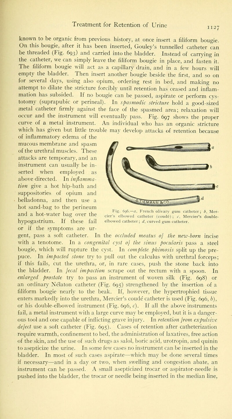 Treatment for Retention of Urine 1127 known to be organic from previous history, at once insert a filiform bougie. On this bougie, after it has been inserted, Gouley's tunnelled catheter can be threaded (Fig. 693) and carried into the bladder. Instead of carrying in the catheter, we can simply leave the filiform bougie in place, and fasten it. The fihform bougie will act as a capillary drain, and in a few hours will empty the bladder. Then insert another bougie beside the first, and so on for several days, using also opium, ordering rest in bed, and making no attempt to dilate the stricture forcibly until retention has ceased and inflam- mation has subsided. If no bougie can be passed, aspirate or perform cys- totomy (suprapubic or perineal). In spasmodic stricture hold a good-sized metal catheter firmly against the face of the spasmed area; relaxation will occur and the instrument will eventually pass. Fig. 697 shows the proper curve of a metal instrument. An individual who has an organic stricture which has given but Httle trouble may develop attacks of retention because of inflammatory edema of the mucous membrane and spasm of the urethral muscles. These attacks are temporary, and an instrument can usually be in- serted when employed as above directed. In inflamma- tion give a hot hip-bath and suppositories of opium and belladonna, and then use a hot sand-bag to the perineum and a hot-water bag over the hypogastrium. If these fail or if the symptoms are ur- gent, pass a soft catheter. In the occluded meatus 0} the new-horn incise wath a tenotome. In a congenital cyst of the sinus pocularis pass a steel bougie, which will rupture the cyst. In complete phimosis split up the pre- puce. In impacted stone try to pull out the calculus with urethral forceps; if this fails, cut the urethra, or, in rare cases, push the stone back into the bladder. In jecal impaction scrape out the rectum with a spoon. In enlarged prostate try to pass an instrument of woven silk (Fig. 698) or an ordinary Nelaton catheter (Fig. 695) strengthened by the insertion of a filiform bougie nearly to the beak. If, however, the hypertrophied tissue enters markedly into the urethra, Mercier's coude catheter is used (Fig. 696, h), or his double-elbowed instrument (Fig. 696, c). If all the above instruments fail, a metal instrument with a large curve may be employed, but it is a danger- ous tool and one capable of inflicting grave injury. In retention from expulsive defect use a soft catheter (Fig. 695). Cases of retention after catheterization require warmth, confinement to bed, the administration of laxatives, free action of the skin, and the use of such drugs as salol, boric acid, urotropin, and quinin to asepticize the urine. In some few cases no instrument can be inserted in the bladder. In most of such cases aspirate—which may be done several times if necessary—and in a day or two, when swelling and congestion abate, an instrument can be passed. A small asepticized trocar or aspirator-needle is pushed into the bladder, the trocar or needle being inserted in the median line, Fig. 696.—a, French olivary gum catheter; b, Mer- cier's elbowed catheter (coude) ; c, Mercier's double- elbowed catheter; d, curved gum catheter.