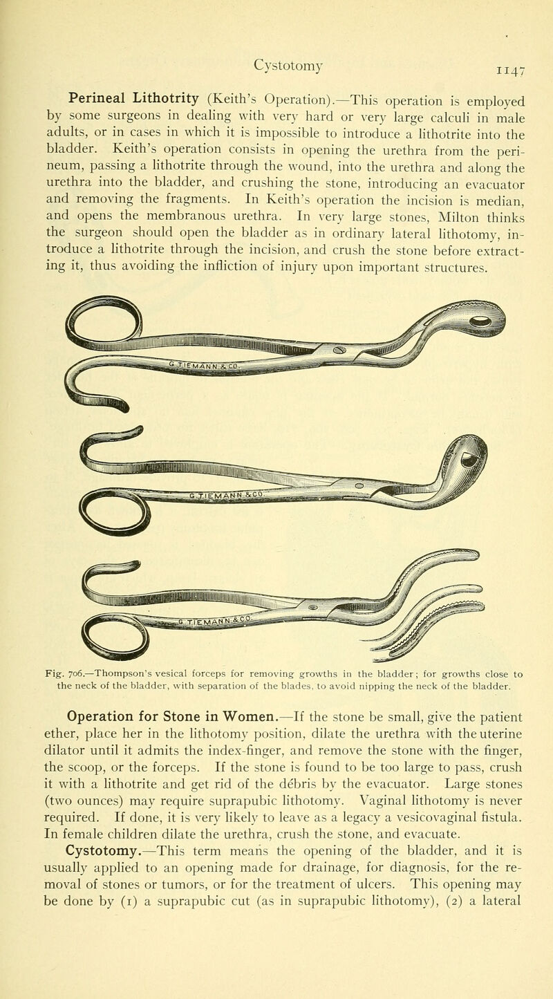 Cystotomy 1147 Perineal Lithotrity (Keith's Operation).—This operation is employed by some surgeons in dealing with very hard or very large calculi in male adults, or in cases in which it is impossible to introduce a lithotrite into the bladder. Keith's operation consists in opening the urethra from the peri- neum, passing a lithotrite through the wound, into the urethra and along the urethra into the bladder, and crushing the stone, introducing an evacuator and removing the fragments. In Keith's operation the incision is median, and opens the membranous urethra. In very large stones, Milton thinks the surgeon should open the bladder as in ordinary lateral lithotomy, in- troduce a Uthotrite through the incision, and crush the stone before extract- ing it, thus avoiding the infliction of injury upon important structures. Fig. 706.—Thompson's vesical forceps for removing growths in the bladder; for growths close to the neck of the bladder, with separation of the blades, to avoid nipping the neck of the bladder. Operation for Stone in Women.—If the stone be small, give the patient ether, place her in the lithotomy position, dilate the urethra with the uterine dilator until it admits the index-finger, and remove the stone with the finger, the scoop, or the forceps. If the stone is found to be too large to pass, crush it with a lithotrite and get rid of the debris by the evacuator. Large stones (two ounces) may require suprapubic lithotomy. Vaginal lithotomy is never required. If done, it is very likely to leave as a legacy a vesicovaginal fistula. In female children dilate the urethra, crush the stone, and evacuate. Cystotomy.—This term means the opening of the bladder, and it is usually applied to an opening made for drainage, for diagnosis, for the re- moval of stones or tumors, or for the treatment of ulcers. This opening may be done by (i) a suprapubic cut (as in suprapubic lithotomy), (2) a lateral