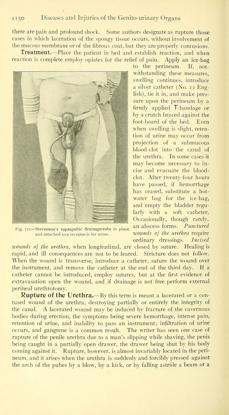 there are pain and profound shock. Some authors designate as rupture those cases in which laceration of the spongy tissue occurs, without involvement of the mucous membrane or of the fibrous coat, but they are properly contusions. Treatment.—Place the patient in bed and estabhsh reaction, and when reaction is complete employ opiates for the relief of pain. Apply an ice-bag to the perineum. If, not- withstanding these measures, swelling continues, introduce a silver catheter (No. 12 Eng- lish), tie it in, and make pres- sure upon the perineum by a firmly applied T-bandage or by a crutch braced against the foot-board of the bed. Even when swelling is slight, reten- tion of urine may occur from projection of a submucous blood-clot into the canal of the urethra. In some cases it may become necessary to in- cise and evacuate the blood- clot. After twenty-four hours have passed, if hemorrhage has ceased, substitute a hot- water bag for the ice-bag, and empty the bladder regu- larly with a soft catheter. Occasionally, though rarely, an abscess forms. Punctured wounds 0} the urethra require ordinary dressings. Incised wounds of the urethra, when longitudinal, are closed by suture. Healing is rapid, and ill consequences are not to be feared. Stricture does not follow. When the wound is transverse, introduce a catheter, suture the wound over the instrument, and remove the catheter at the end of the third day. If a catheter cannot be introduced, employ sutures, but at the first evidence of extravasation open the wound, and if drainage is not free perform external perineal urethrotomy. Rupture of the Urethra.—By this term is meant a lacerated or a con- tused wound of the urethra, destroying partially or entirely the integrity of the canal. A lacerated wound may be induced by fracture of the cavernous bodies during erection, the symptoms being severe hemorrhage, intense pain, retention of urine, and inability to pass an instrument; infiltration of urine occurs, and gangrene is a common result. The writer has seen one case of rupture of the penile urethra due to a man's slipping while shaving, the penis being caught in a partially open drawer, the drawer being shut by his body coming against it. Rupture, however, is almost invariably located in the peri- neum, and it arises when the urethra is suddenly and forcibly pressed against the arch of the pubes by a blow, by a kick, or by falling astride a beam or a Fig. 710.—Stevenson's suprapubic drainage-tube in place and attached to a receptacle for urine.
