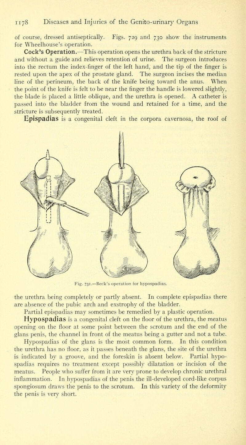of course, dressed andseptically. Figs. 729 and 730 show the instruments for Wheelhouse's operation. Cock's Operation.—This operation opens the urethra back of the stricture and without a guide and reheves retention of urine. The surgeon introduces into the rectum the index-finger of the left hand, and the tip of the finger is rested upon the apex of the prostate gland. The surgeon incises the median line of the perineum, the back of the knife being toward the anus. When the point of the knife is felt to be near the finger the handle is lowered slightly, the blade is placed a little obhque, and the urethra is opened. A catheter is passed into the bladder from the wound and retained for a time, and the stricture is subsequently treated. Epispadias is a congenital cleft in the corpora cavernosa, the roof of Fig. 731.—Beck's operation for hypospadias. the urethra being completely or partly absent. In complete epispadias there are absence of the pubic arch and exstrophy of the bladder. Partial epispadias may sometimes be remedied by a plastic operation. Hypospadias is a congenital cleft on the floor of the urethra, the meatus opening on the floor at some point between the scrotum and the end of the glans penis, the channel in front of the meatus being a gutter and not a tube. Hypospadias of the glans is the most common form. In this condition the urethra has no floor, as it passes beneath the glans, the site of the urethra is indicated by a groove, and the foreskin is absent below. Partial hypo- spadias requires no treatment except possibly dilatation or incision of the meatus. People who suffer from it are very prone to develop chronic urethral inflammation. In hypospadias of the penis the ill-developed cord-like corpus spongiosum draws the penis to the scrotum. In this variety of the deformity the penis is very short.