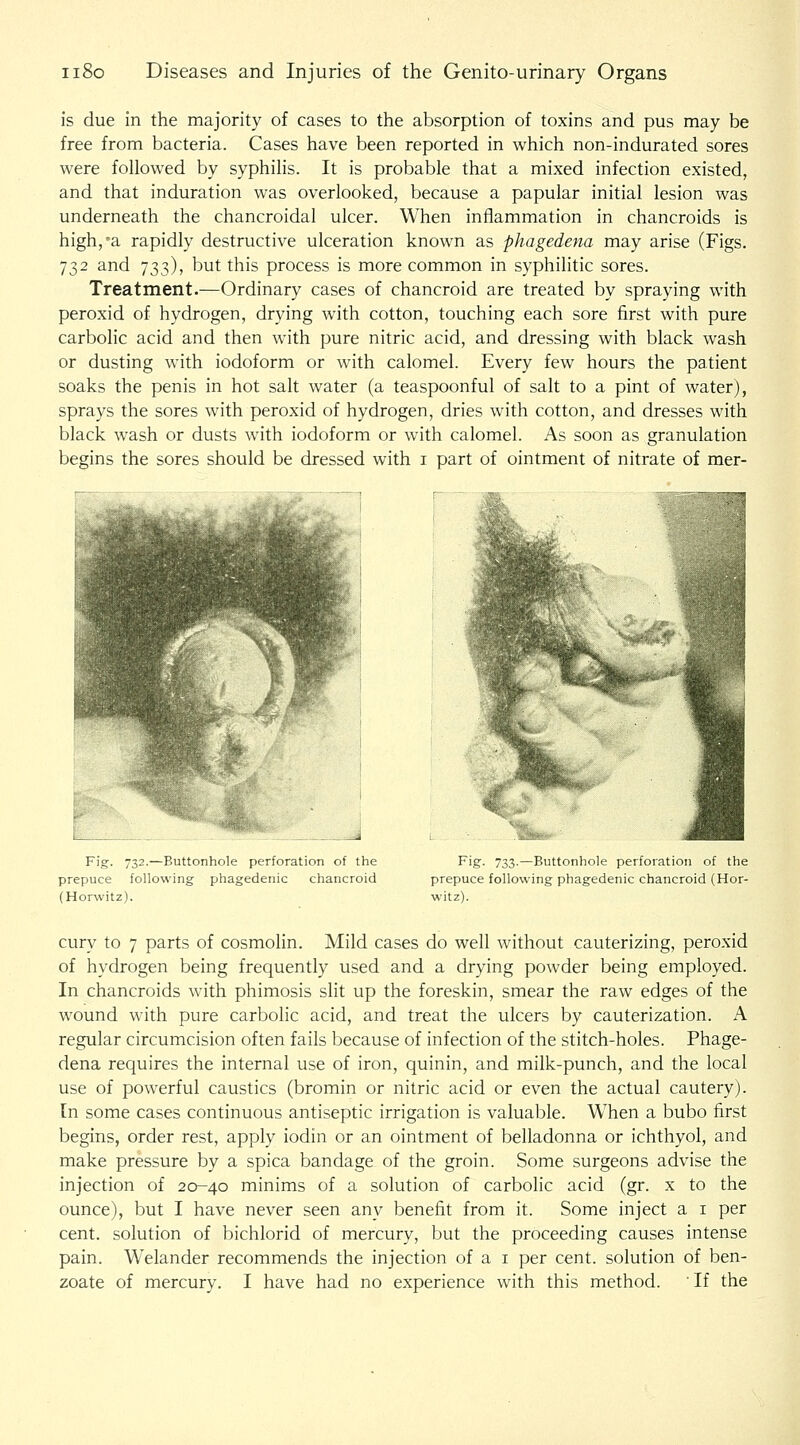 is due in the majority of cases to the absorption of toxins and pus may be free from bacteria. Cases have been reported in which non-indurated sores were followed by syphilis. It is probable that a mixed infection existed, and that induration was overlooked, because a papular initial lesion was underneath the chancroidal ulcer. When inflammation in chancroids is high,'a rapidly destructive ulceration known as phagedena may arise (Figs. 732 and 733), but this process is more common in syphilitic sores. Treatment.—Ordinary cases of chancroid are treated by spraying with peroxid of hydrogen, drying with cotton, touching each sore first with pure carbolic acid and then with pure nitric acid, and dressing with black wash or dusting with iodoform or with calomel. Every few hours the patient soaks the penis in hot salt water (a teaspoonful of salt to a pint of water), sprays the sores with peroxid of hydrogen, dries with cotton, and dresses with black wash or dusts with iodoform or with calomel. As soon as granulation begins the sores should be dressed with i part of ointment of nitrate of mer- Fig. 732.—Buttonhole perforation of the prepuce following phagedenic chancroid (Horwitz). Fig. 733.—Buttonhole perforation of the prepuce following phagedenic chancroid (Hor- witz). cury to 7 parts of cosmolin. Mild cases do well without cauterizing, peroxid of hydrogen being frequently used and a drying powder being employed. In chancroids with phimosis slit up the foreskin, smear the raw edges of the wound with pure carbolic acid, and treat the ulcers by cauterization. A regular circumcision often fails because of infection of the stitch-holes. Phage- dena requires the internal use of iron, quinin, and milk-punch, and the local use of powerful caustics (bromin or nitric acid or even the actual cautery), [n some cases continuous antiseptic irrigation is valuable. When a bubo fi.rst begins, order rest, apply iodin or an ointment of belladonna or ichthyol, and make pressure by a spica bandage of the groin. Some surgeons advise the injection of 20-40 minims of a solution of carbolic acid (gr. x to the ounce), but I have never seen any benefit from it. Some inject a i per cent, solution of bichlorid of mercury, but the proceeding causes intense pain. Welander recommends the injection of a i per cent, solution of ben-
