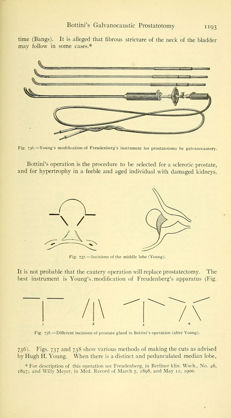 Bottini's Galvanocaustic Prostatotomy time (Bangs). It is alleged that fibrous stricture of the neck of the bladder mav follow in some cases.* Fig. 736.—Young's modification of Freudenberg's instrument for prostatotomy by galvanocautery. Bottini's operation is the procedure to be selected for a sclerotic prostate, and for hypertrophy in a feeble and aged individual with damaged kidneys. \ / Fig. 737.—Incisions of the middle lobe (Young). It is not probable that the cautery operation will replace prostatectomy. The best instrument is Young's. modification of Freudenberg's apparatus (Fig. , 2 J 4 Fig- 738-—Different incisions of prostate gland in Bottini's operation (after Young). 736). Figs. 737 and 738 show various methods of making the cuts as advised by Hugh H. Young. When there is a distinct and pedunculated median lobe, * For description of this operation see Freudenberg, in Berliner klin. Woch., No. 46, 1897; and Willy Meyer, in Med. Record of March 5, 1898, and May 12, 1900.
