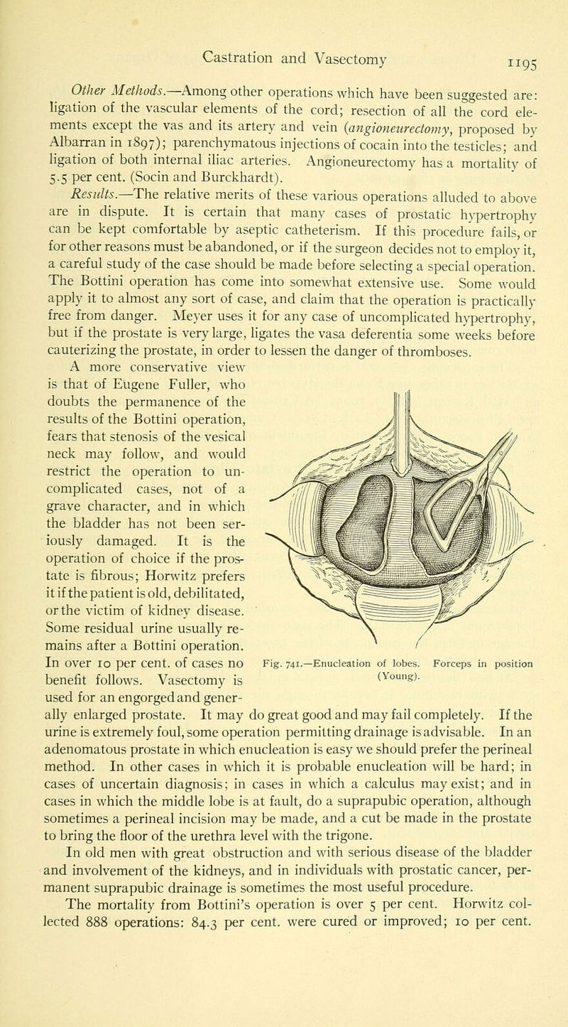 Castration and Vasectomy Other Methods.—Among other operations which have been suggested are: ligation of the vascular elements of the cord; resection of all the cord ele- ments except the vas and its artery and vein {angioneurectomy, proposed by Albarran in 1897); parenchymatous injections of cocain into the testicles; and ligation of both internal iliac arteries. Angioneurectomy has a mortality of 5.5 per cent. (Socin and Burckhardt). Results.—T\\e relative merits of these various operations alluded to above are in dispute. It is certain that many cases of prostatic hypertrophy can be kept comfortable by aseptic catheterism. If this procedure fails, or for other reasons must be abandoned, or if the surgeon decides not to employ it, a careful study of the case should be made before selecting a special operation. The Bottini operation has come into somewhat extensive use. Some would apply it to almost any sort of case, and claim that the operation is practically free from danger. Meyer uses it for any case of uncomplicated hypertrophy, but if the prostate is very large, ligates the vasa deferentia some weeks before cauterizing the prostate, in order to lessen the danger of thromboses. A more conserv^ative view is that of Eugene Fuller, who doubts the permanence of the results of the Bottini operation, fears that stenosis of the vesical neck may follow, and would restrict the operation to un- complicated cases, not of a grave character, and in which the bladder has not been ser- iously damaged. It is the operation of choice if the pros- tate is fibrous; Horwitz prefers it if the patient is old, debilitated, or the victim of kidney disease. Some residual urine usually re- mains after a Bottini operation. In over 10 per cent, of cases no benefit follows. Vasectomy is used for an engorged and gener- ally enlarged prostate. It may do great good and may fail completely. If the urine is extremely foul, some operation permitting drainage is advisable. In an adenomatous prostate in which enucleation is easy we should prefer the perineal method. In other cases in which it is probable enucleation will be hard; in cases of uncertain diagnosis; in cases in which a calculus may exist; and in cases in which the middle lobe is at fault, do a suprapubic operation, although sometimes a perineal incision may be made, and a cut be made in the prostate to bring the floor of the urethra level with the trigone. In old men with great obstruction and with serious disease of the bladder and involvement of the kidneys, and in individuals with prostatic cancer, per- manent suprapubic drainage is sometimes the most useful procedure. The mortality from Bottini's operation is over 5 per cent. Horwitz col- lected 888 operations: 84.3 per cent, were cured or improved; 10 per cent. Fig. 741.—Enucleation of lobes. (Young). Forceps in position