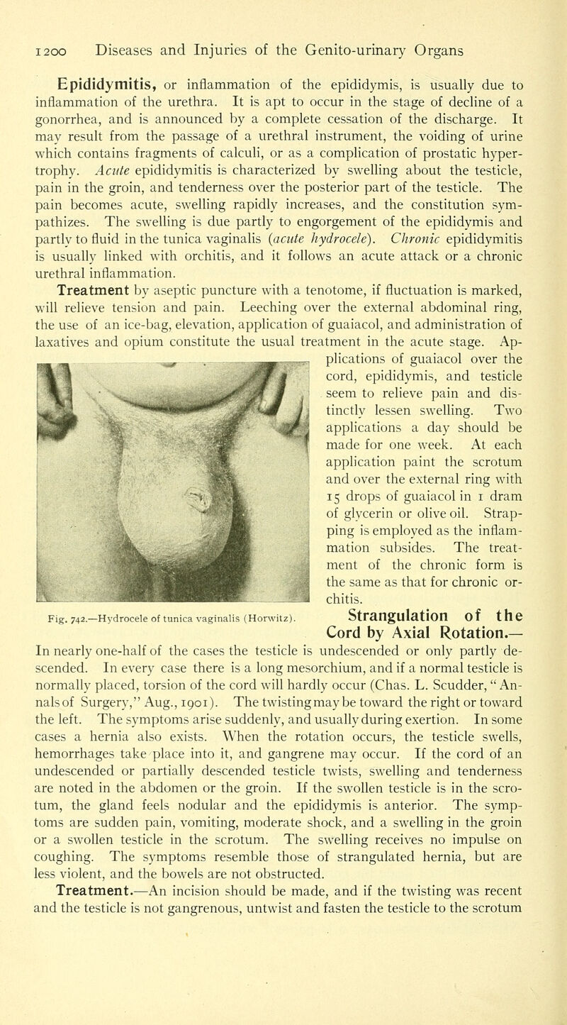Epididymitis, or inflammation of the epididymis, is usually due to inflammation of the urethra. It is apt to occur in the stage of decline of a gonorrhea, and is announced by a complete cessation of the discharge. It may result from the passage of a urethral instrument, the voiding of urine which contains fragments of calculi, or as a complication of prostatic hyper- trophy. Acute epididymitis is characterized by swelling about the testicle, pain in the groin, and tenderness over the posterior part of the testicle. The pain becomes acute, swelling rapidly increases, and the constitution sym- pathizes. The swelling is due partly to engorgement of the epididymis and partly to fluid in the tunica vaginalis (acute hydrocele). Chronic epididymitis is usually linked with orchitis, and it follows an acute attack or a chronic urethral inflammation. Treatment by aseptic puncture with a tenotome, if fluctuation is marked, will relieve tension and pain. Leeching over the external abdominal ring, the use of an ice-bag, elevation, application of guaiacol, and administration of laxatives and opium constitute the usual treatment in the acute stage. Ap- plications of guaiacol over the cord, epididymis, and testicle seem to relieve pain and dis- tinctly lessen swelhng. Two applications a day should be made for one week. At each application paint the scrotum and over the external ring with 15 drops of guaiacol in i dram of glycerin or olive oil. Strap- ping is employed as the inflam- mation subsides. The treat- ment of the chronic form is the same as that for chronic or- chitis. Strangulation of the Cord by Axial Rotation.— In nearly one-half of the cases the testicle is undescended or only partly de- scended. In every case there is a long mesorchium, and if a normal testicle is normally placed, torsion of the cord will hardly occur (Chas. L. Scudder,  An- nalsof Surgery, Aug., 1901). The twistingmay be toward the right or toward the left. The symptoms arise suddenly, and usually during exertion. In some cases a hernia also exists. When the rotation occurs, the testicle swells, hemorrhages take place into it, and gangrene may occur. If the cord of an undescended or partially descended testicle twists, swelhng and tenderness are noted in the abdomen or the groin. If the swollen testicle is in the scro- tum, the gland feels nodular and the epididymis is anterior. The symp- toms are sudden pain, vomiting, moderate shock, and a swelling in the groin or a swollen testicle in the scrotum. The swelling receives no impulse on coughing. The symptoms resemble those of strangulated hernia, but are less violent, and the bowels are not obstructed. Treatment.—An incision should be made, and if the twisting was recent and the testicle is not gangrenous, untwist and fasten the testicle to the scrotum Fig. 742.—Hydrocele of tunica vaginalis (Horwitz).