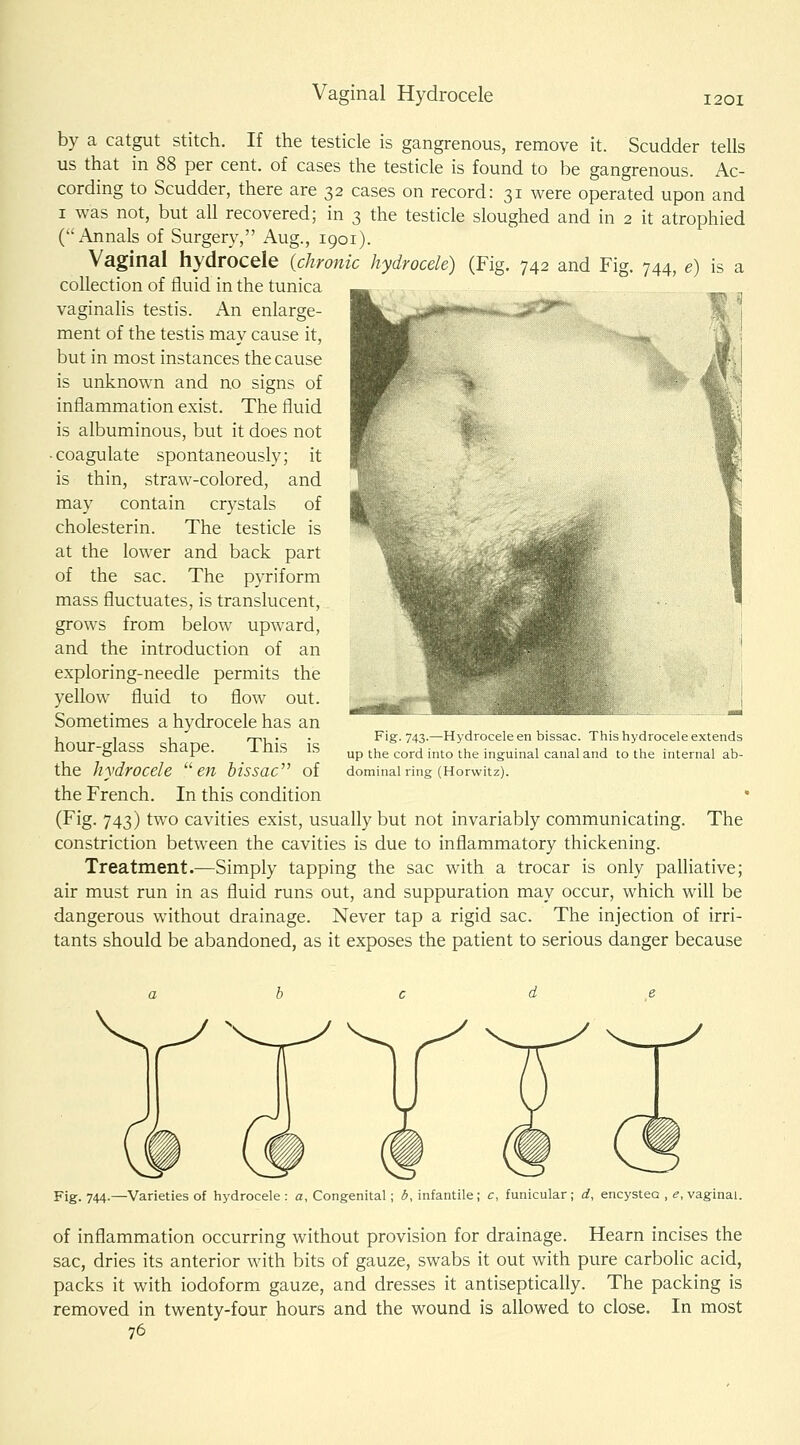 Vaginal Hydrocele by a catgut stitch. If the testicle is gangrenous, remove it. Scudder tells us that in 88 per cent, of cases the testicle is found to be gangrenous. Ac- cording to Scudder, there are 32 cases on record: 31 were operated upon and I was not, but all recovered; in 3 the testicle sloughed and in 2 it atrophied (Annals of Surgery, Aug., 1901). Vaginal hydrocele {chronic hydrocele) (Fig. 742 and Fig. 744, e) is a collection of fluid in the tunica ^ vaginalis testis. An enlarge- '^'^^ -.**«wi«^ ment of the testis may cause it, but in most instances the cause is unknown and no signs of inflammation exist. The fluid is albuminous, but it does not • coagulate spontaneously; it is thin, straw-colored, and may contain crystals of cholesterin. The testicle is at the lower and back part of the sac. The pyriform mass fluctuates, is translucent, grows from below upward, and the introduction of an exploring-needle permits the yellow fluid to flow out. Sometimes a hydrocele has an hour-glass shape. This is the hydrocele ew bissac of the French. In this condition (Fig. 743) two cavities exist, usually but not invariably communicating, constriction between the cavities is due to inflammatory thickening. Treatment.—Simply tapping the sac with a trocar is only palhative; air must run in as fluid runs out, and suppuration may occur, which will be dangerous without drainage. Never tap a rigid sac. The injection of irri- tants should be abandoned, as it exposes the patient to serious danger because J Fig. 743.—Hydrocele en bissac. This hydrocele extends up the cord into the inguinal canal and to the internal ab- dominal ring (Horwitz). The Fig. 744.—Varieties of hydrocele : a. Congenital; b, infantile ; c, funicular ; d, encysteo , <?, vaginal. of inflammation occurring without provision for drainage. Hearn incises the sac, dries its anterior with bits of gauze, swabs it out with pure carbolic acid, packs it with iodoform gauze, and dresses it antiseptically. The packing is removed in twenty-four hours and the wound is allowed to close. In most 76