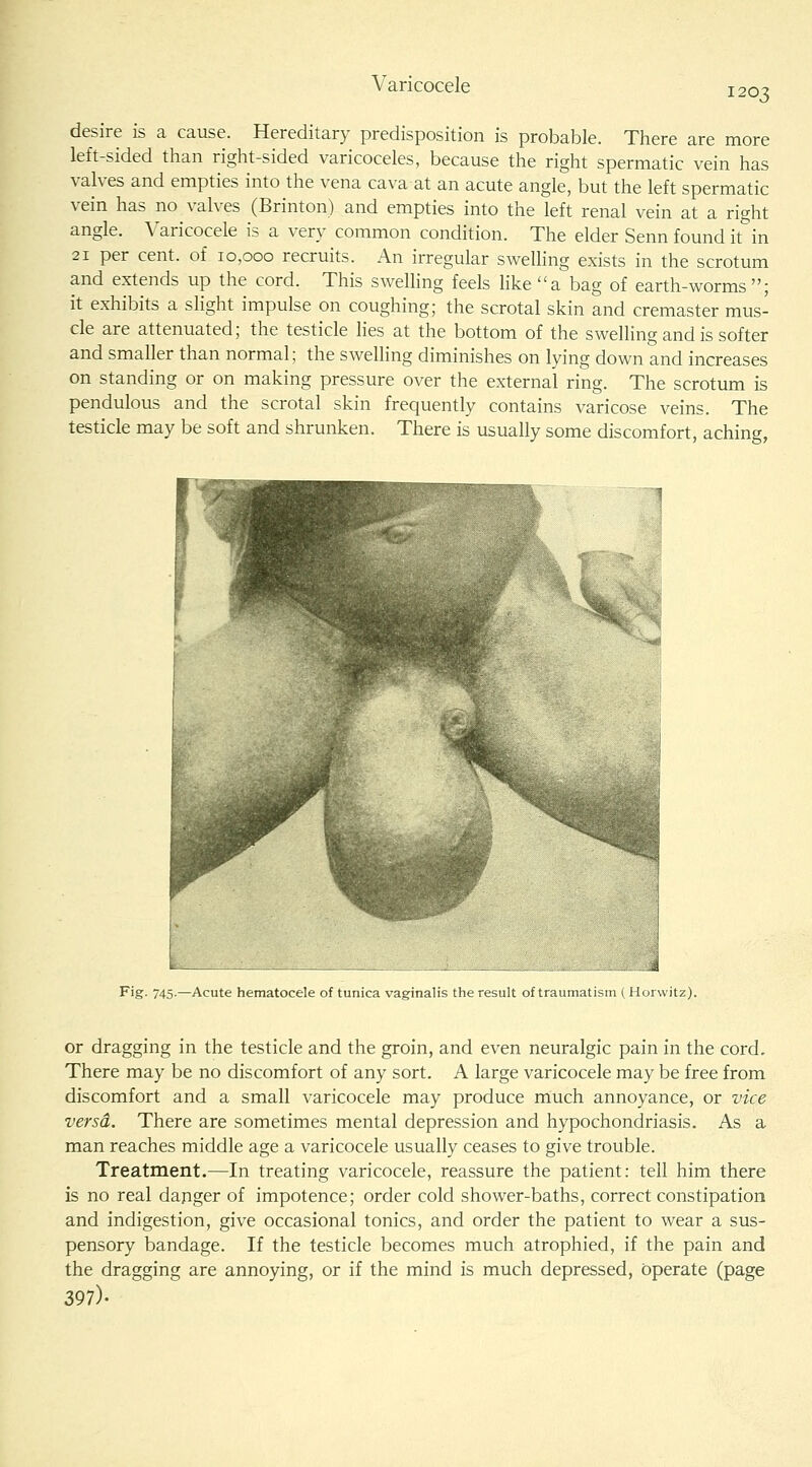 Varicocele 1203 desire is a cause. Hereditary predisposition is probable. There are more left-sided than right-sided varicoceles, because the right spermatic vein has valves and empties into the vena cava at an acute angle, but the left spermatic vein has no valves (Brinton) and empties into the left renal vein at a right angle. Varicocele is a very common condition. The elder Senn found it in 21 per cent, of 10,000 recruits. An irregular swelling exists in the scrotum and extends up the cord. This swelling feels like a bag of earth-worms ; it exhibits a slight impulse on coughing; the scrotal skin and cremaster mus- cle are attenuated; the testicle hes at the bottom of the swelling and is softer and smaller than normal; the swelling diminishes on lying down and increases on standing or on making pressure over the external ring. The scrotum is pendulous and the scrotal skin frequently contains varicose veins. The testicle may be soft and shrunken. There is usually some discomfort, aching, F'g- 745-—Acute hematocele of tunica vaginalis the result of traumatism (Horwitz). or dragging in the testicle and the groin, and even neuralgic pain in the cord. There may be no discomfort of any sort. A large varicocele may be free from discomfort and a small varicocele may produce much annoyance, or vice versa. There are sometimes mental depression and hypochondriasis. As a man reaches middle age a varicocele usually ceases to give trouble. Treatment.—In treating varicocele, reassure the patient: tell him there is no real danger of impotence; order cold shower-baths, correct constipation and indigestion, give occasional tonics, and order the patient to wear a sus- pensory bandage. If the testicle becomes much atrophied, if the pain and the dragging are annoying, or if the mind is much depressed, operate (page 397)-