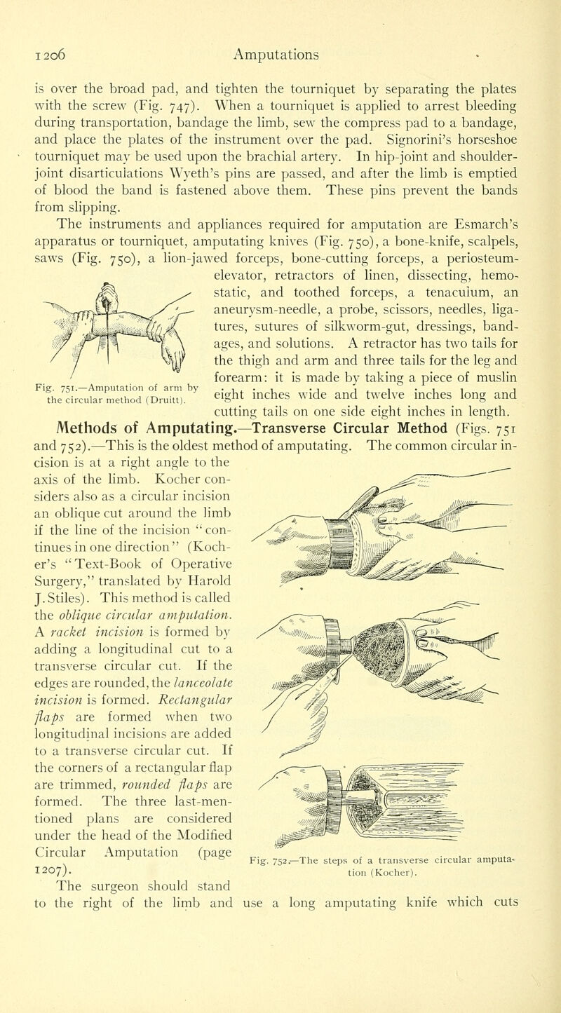Fig. 751.—Amputation of arm by the circular method (Druitt). is over the broad pad, and tighten the tourniquet by separating the plates with the screw (Fig. 747). When a tourniquet is applied to arrest bleeding during transportation, bandage the limb, sew the compress pad to a bandage, and place the plates of the instrument over the pad. Signorini's horseshoe tourniquet may be used upon the brachial artery. In hip-joint and shoulder- joint disarticulations Wyeth's pins are passed, and after the limb is emptied of blood the band is fastened above them. These pins prevent the bands from slipping. The instruments and appliances required for amputation are Esmarch's apparatus or tourniquet, amputating knives (Fig. 750), a bone-knife, scalpels, saws (Fig. 750), a lion-jawed forceps, bone-cutting forceps, a periosteum- elevator, retractors of linen, dissecting, hemo- static, and toothed forceps, a tenaculum, an aneurysm-needle, a probe, scissors, needles, liga- tures, sutures of silkworm-gut, dressings, band- ages, and solutions. A retractor has two tails for the thigh and arm and three tails for the leg and forearm: it is made by taking a piece of muslin eight inches wide and twelve inches long and cutting tails on one side eight inches in length. Methods of Amputating.—Transverse Circular Method (Figs. 751 and 752).—This is the oldest method of amputating. The common circular in- cision is at a right angle to the axis of the limb. Kocher con- siders also as a circular incision an oblique cut around the limb if the line of the incision  con- tinues in one direction  (Koch- er's Text-Book of Operative Surgery, translated by Harold J. Stiles). This method is called the oblique circular amputation. A racket incision is formed by adding a longitudinal cut to a transverse circular cut. If the edges are rounded, the lanceolate incision is formed. Rectangular flaps are formed when two longitudinal incisions are added to a transverse circular cut. If the corners of a rectangular flap are trimmed, rounded flaps are formed. The three last-men- tioned plans are considered under the head of the Modified Circular Amputation (page 1207). The surgeon should stand to the right of the limb and Fig. 752.—The steps of a transverse circular amputa- tion (Kocher). use a long amputating knife which cuts