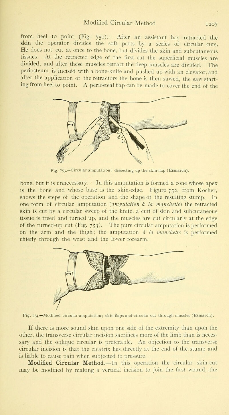 Modified Circular Method from heel to point (Fig. 751). After an assistant has retracted the skin the operator divides the soft parts by a series of circular cuts. He does not cut at once to the bone, but divides the skin and subcutaneous tissues. At the retracted edge of the first cut the superficial muscles are divided, and after these muscles retract the deep muscles are divided. The periosteum is incised with a bone-knife and pushed up with an elevator, and after the appHcation of the retractors the bone is then sawed, the saw start- ing from heel to point. A periosteal flap can be made to cover the end of the Fig. 753.—Circular amputation ; dissecting up tiie skin-flap (Esmarcli). bone, but it is unnecessary. In this amputation is formed a cone whose apex is the bone and whose base is the skin-edge. Figure 752, from Kocher, shows the steps of the operation and the shape of the resulting stump. In one form of circular amputation {amputation a la nianchette) the retracted skin is cut by a circular sweep of the knife, a cuff of skin and subcutaneous tissue is freed and turned up, and the muscles are cut circularly at the edge of the turned-up cut (Fig. 753). The pure circular amputation is performed on the arm and the thigh; the amputation a la manchette is performed chiefly through the wrist and the lower forearm. Fig. 754.—Modified circular amputation; slcin-flaps and circular cut through muscles (Esmarch). If there is more sound skin upon one side of the extremity than upon the other, the transverse circular incision sacrifices more of the limb than is neces- sary and the oblique circular is preferable. An objection to the transverse circular incision is that the cicatrix lies directly at the end of the.stump and is liable to cause pain when subjected to pressure. Modified Circular Method.—In this operation the circular skin-cut may be modified by making a vertical incision to join the first wound, the
