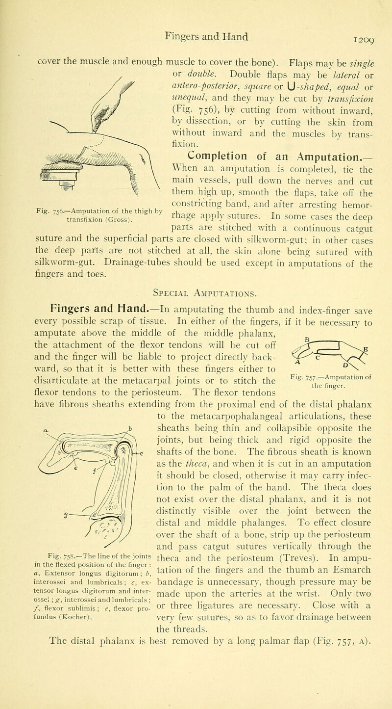 Fingers and Hand 1209 Fig. 756.—Amputation of the thigh by transfixion (Gross). cover the muscle and enough muscle to cover the bone). Flaps may be single or double. Double flaps may be lateral or antero-posterior, square or U -shaped, equal or unequal, and they may be cut by transfixion (Fig- 756), by cutting from without inward, by dissection, or by cutting the skin from without inward and the muscles by trans- fixion. Completion of an Amputation.— When an amputation is completed, tie the main vessels, pull down the nerves and cut them high up, smooth the flaps, take off the constricting band, and after arresting hemor- rhage apply sutures. In some cases the deep parts are stitched with a continuous catgut suture and the superficial parts are closed with silkworm-gut; in other cases the deep parts are not stitched at all, the skin alone being sutured with silkworm-gut. Drainage-tubes should be used except in amputations of the fingers and toes. Special Amputations. Fingers and Hand.—In amputating the thumb and index-finger save every possible scrap of tissue. In either of the fingers, if it be necessary to amputate above the middle of the middle phalanx, the attachment of the flexor tendons will be cut off and the finger will be liable to project directly back- ward, so that it is better with these fingers either to disarticulate at the metacarpal joints or to stitch the flexor tendons to the periosteum. The flexor tendons have fibrous sheaths extending from the proximal end of the distal phalanx to the metacarpophalangeal articulations, these sheaths being thin and collapsible opposite the joints, but being thick and rigid opposite the shafts of the bone. The fibrous sheath is known as the theca, and when it is cut in an amputation it should be closed, otherwise it may carry infec- tion to the palm of the hand. The theca does not exist over the distal phalanx, and it is not distinctly visible over the joint between the distal and middle phalanges. To effect closure over the shaft of a bone, strip up the periosteum and pass catgut sutures vertically through the Fig. 758.-The line of the joints ^hg^a and the periosteum (Treves). In ampu- in the flexed position of the finger: . . , „ i 1 1 i -r^ 1 a, Extensor longus digitorum; b, ^atiou of the fingers and the thumb an Esmarch interossei and lumbricais; <:, ex- bandage is Unnecessary, though pressure may be tensor longus digitorum and inter- ^^^^ ^ ^^iQ arteries at the wrist. Only two ossei; ^, interossei and lumbricais; it r^^ • ^ /, flexor subiimis; e, flexor pro- o^ three ligatures are necessary. Close with a fundus (Kocher). Very few suturcs, so as to favor drainage between the threads. The distal phalanx is best removed by a long palmar flap (Fig. 757, a). Fig, 757.—Amputation of the finger.