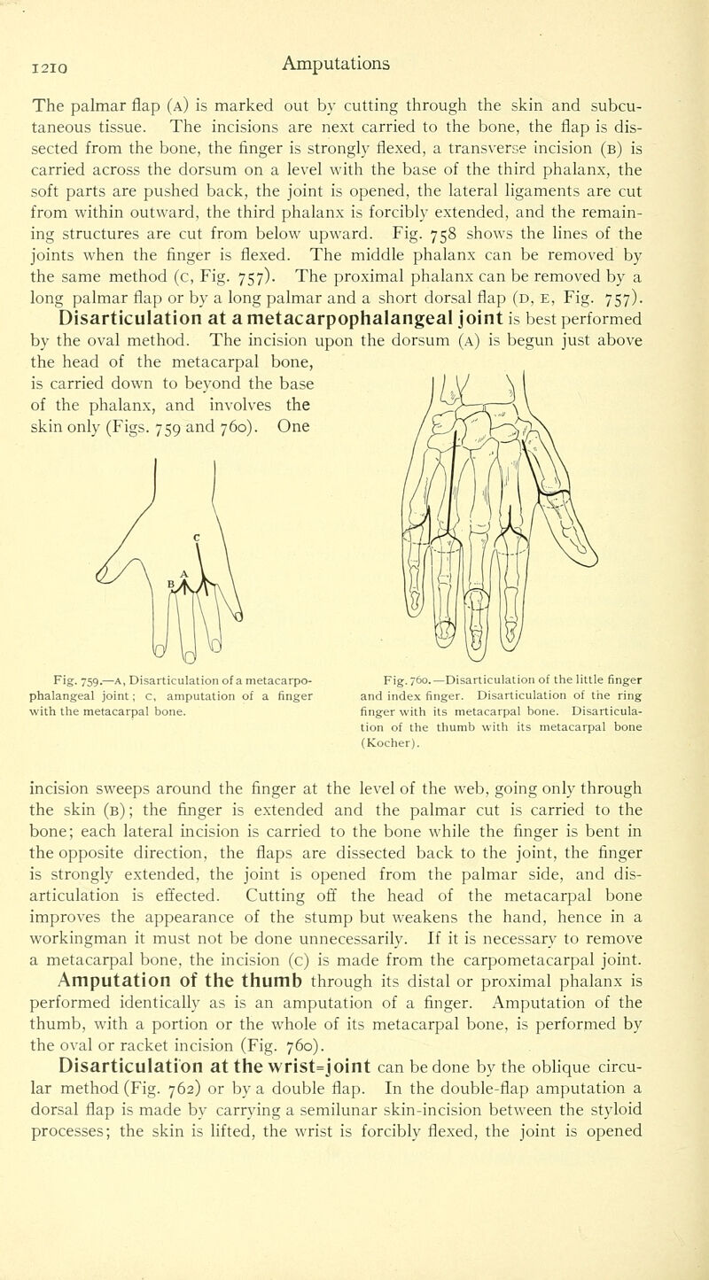 The palmar flap (a) is marked out by cutting througii the skin and subcu- taneous tissue. The incisions are next carried to the bone, the flap is dis- sected from the bone, the finger is strongly flexed, a transverse incision (b) is carried across the dorsum on a level with the base of the third phalanx, the soft parts are pushed back, the joint is opened, the lateral ligaments are cut from within outward, the third phalanx is forcibly extended, and the remain- ing structures are cut from below upward. Fig. 758 shows the lines of the joints when the finger is flexed. The middle phalanx can be removed by the same method (c. Fig. 757). The proximal phalanx can be removed by a long palmar flap or by a long palmar and a short dorsal flap (d, e. Fig. 757). Disarticulation at a metacarpophalangeal joint is best performed by the oval method. The incision upon the dorsum (a) is begun just above the head of the metacarpal bone, is carried down to beyond the base of the phalanx, and involves the skin only (Figs. 759 and 760). One Fig. 759.—A, Disarticulation of a metacarpo- phalangeal joint; c, amputation of a finger with the metacarpal bone. Fig. 760.—Disarticulation of the little finger and index finger. Disarticulation of the ring finger with its metacarpal bone. Disarticula- tion of the thumb with its metacarpal bone (Kocher). incision sweeps around the finger at the level of the web, going only through the skin (b) ; the finger is extended and the palmar cut is carried to the bone; each lateral incision is carried to the bone while the finger is bent in the opposite direction, the flaps are dissected back to the joint, the finger is strongly extended, the joint is opened from the palmar side, and dis- articulation is effected. Cutting off the head of the metacarpal bone improves the appearance of the stump but weakens the hand, hence in a workingman it must not be done unnecessarily. If it is necessary to remove a metacarpal bone, the incision (c) is made from the carpometacarpal joint. Amputation of the thumb through its distal or proximal phalanx is performed identically as is an amputation of a finger. Amputation of the thumb, with a portion or the whole of its metacarpal bone, is performed by the oval or racket incision (Fig. 760). Disarticulation at the wrist=joint can be done by the oblique circu- lar method (Fig. 762) or by a double flap. In the dovible-flap amputation a dorsal flap is made by carrying a semilunar skin-incision between the styloid processes; the skin is lifted, the wrist is forcibly flexed, the joint is opened